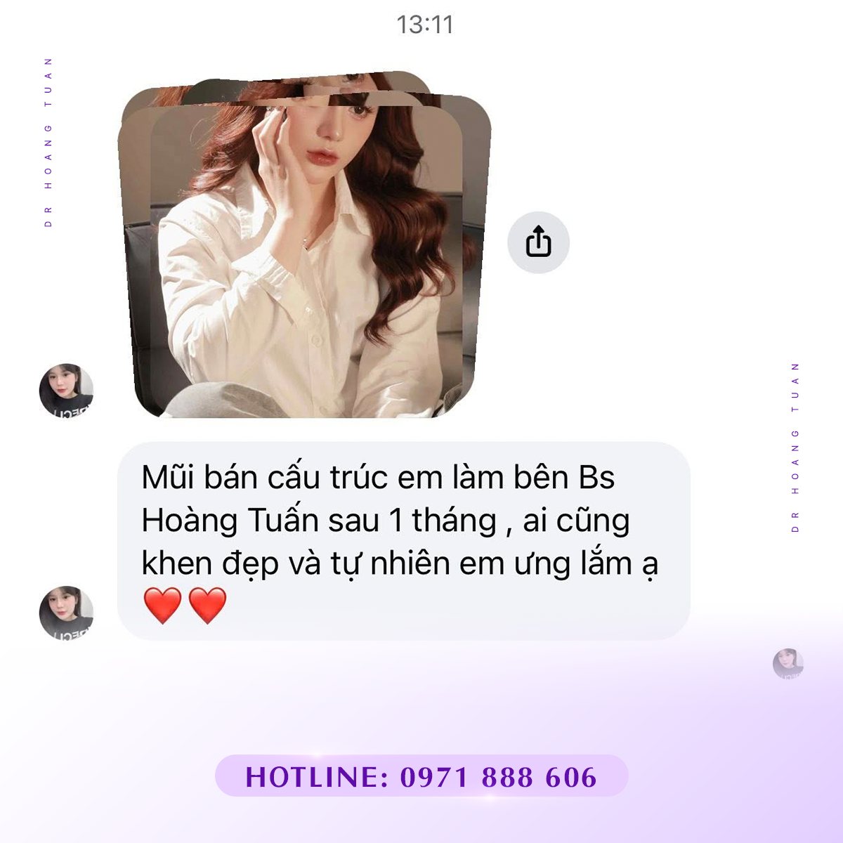 nâng mũi cấu trúc bao lâu thì gom lại