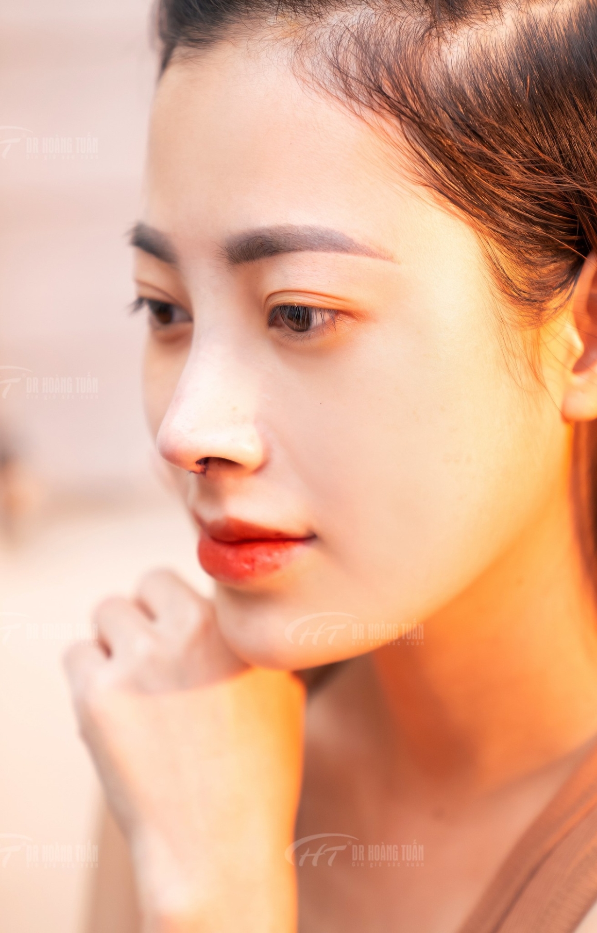 nâng mũi có được lột mụn không