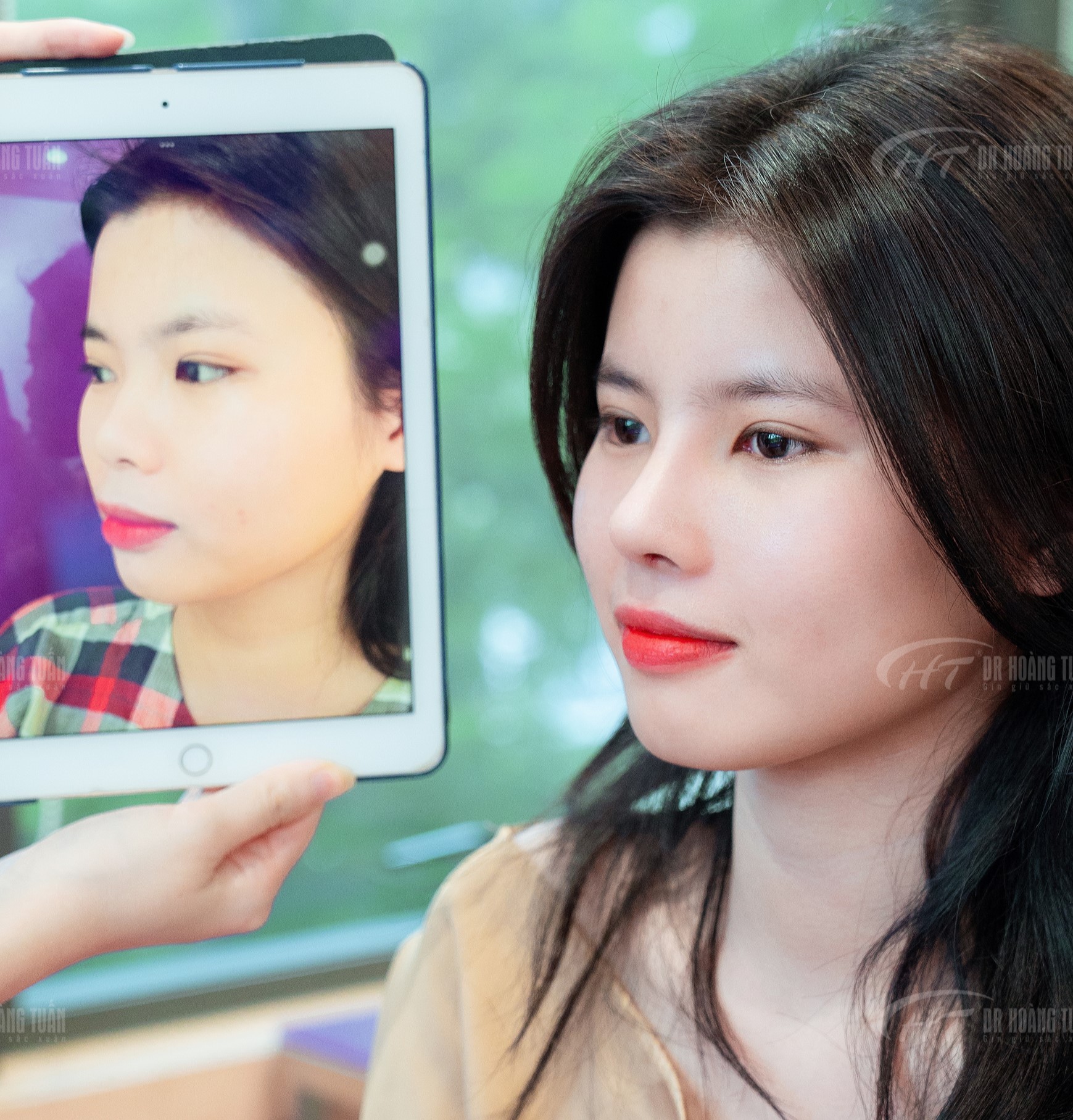 tiêm filler rồi có nâng mũi được không