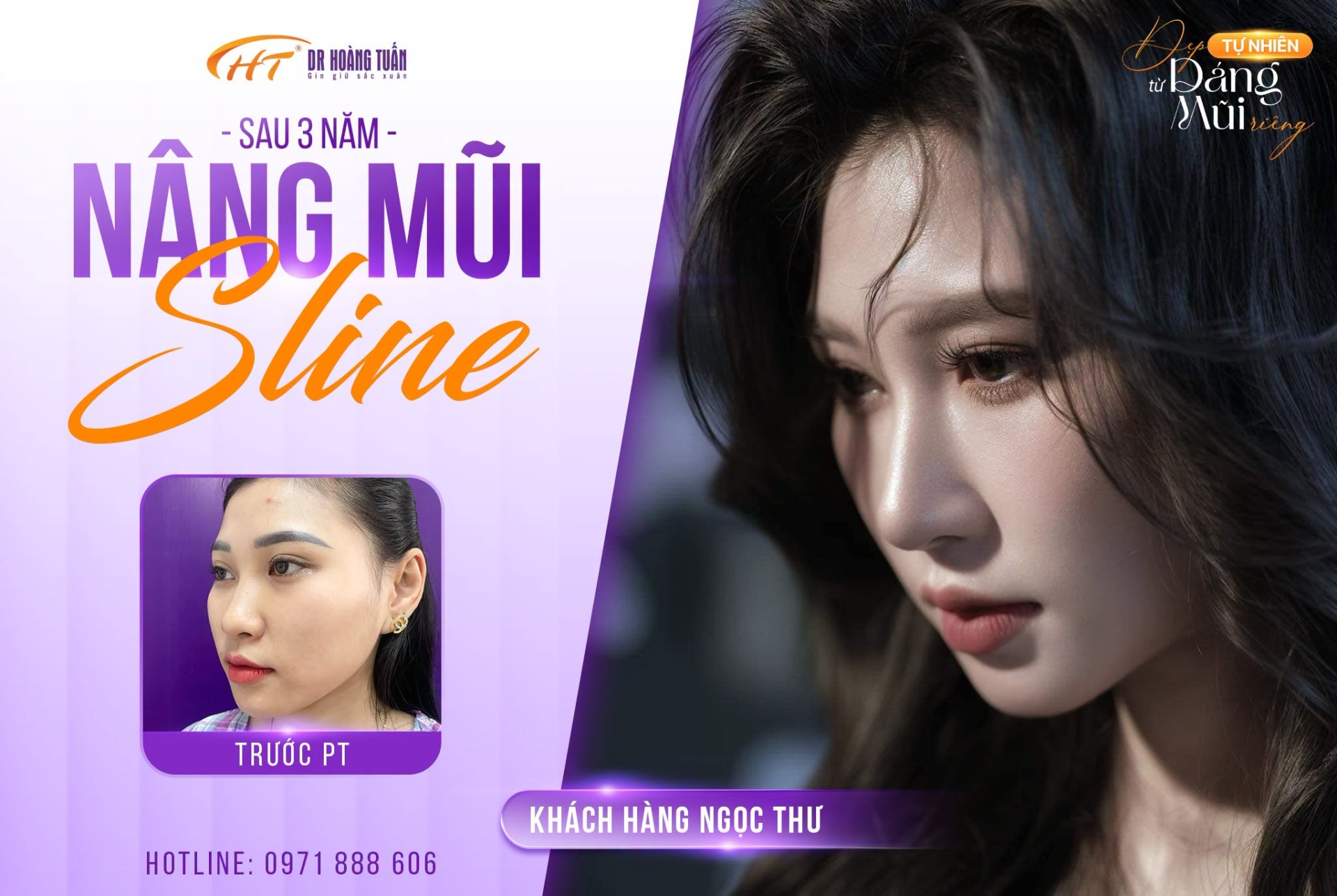 nâng mũi bao lâu thì tự gội đầu được