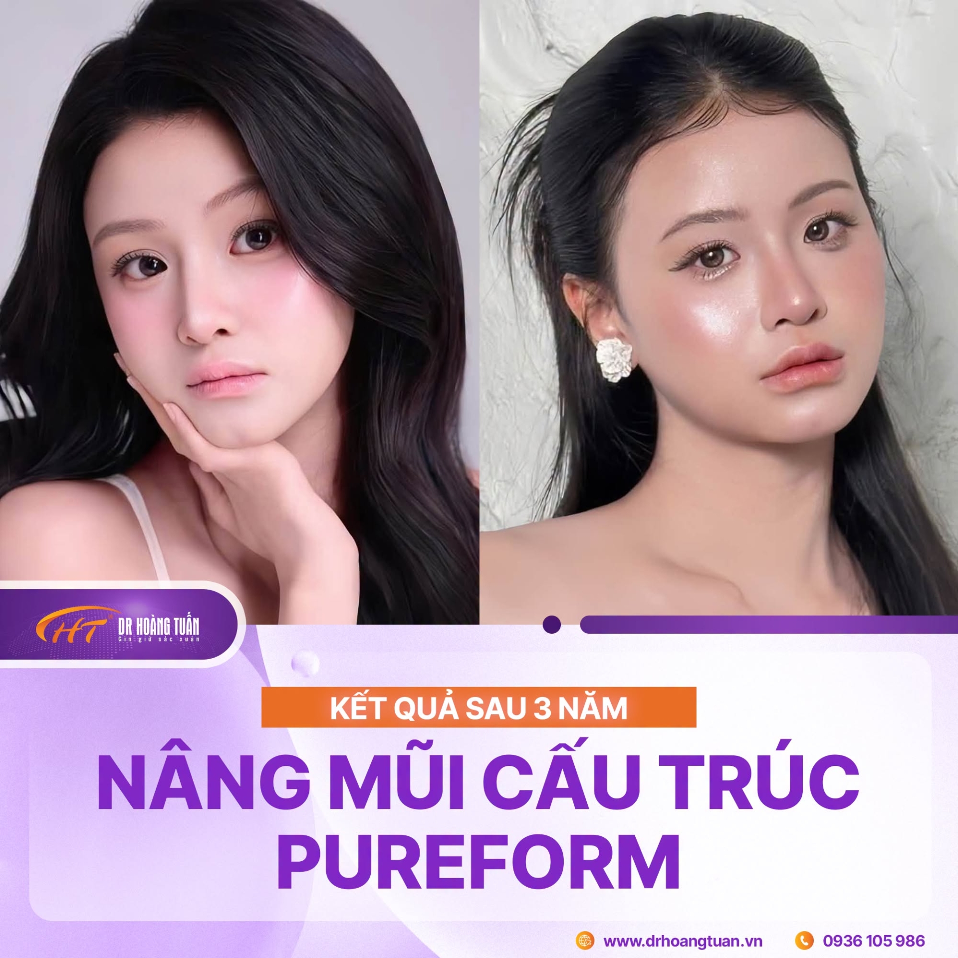 nâng mũi bao lâu thì tự gội đầu được