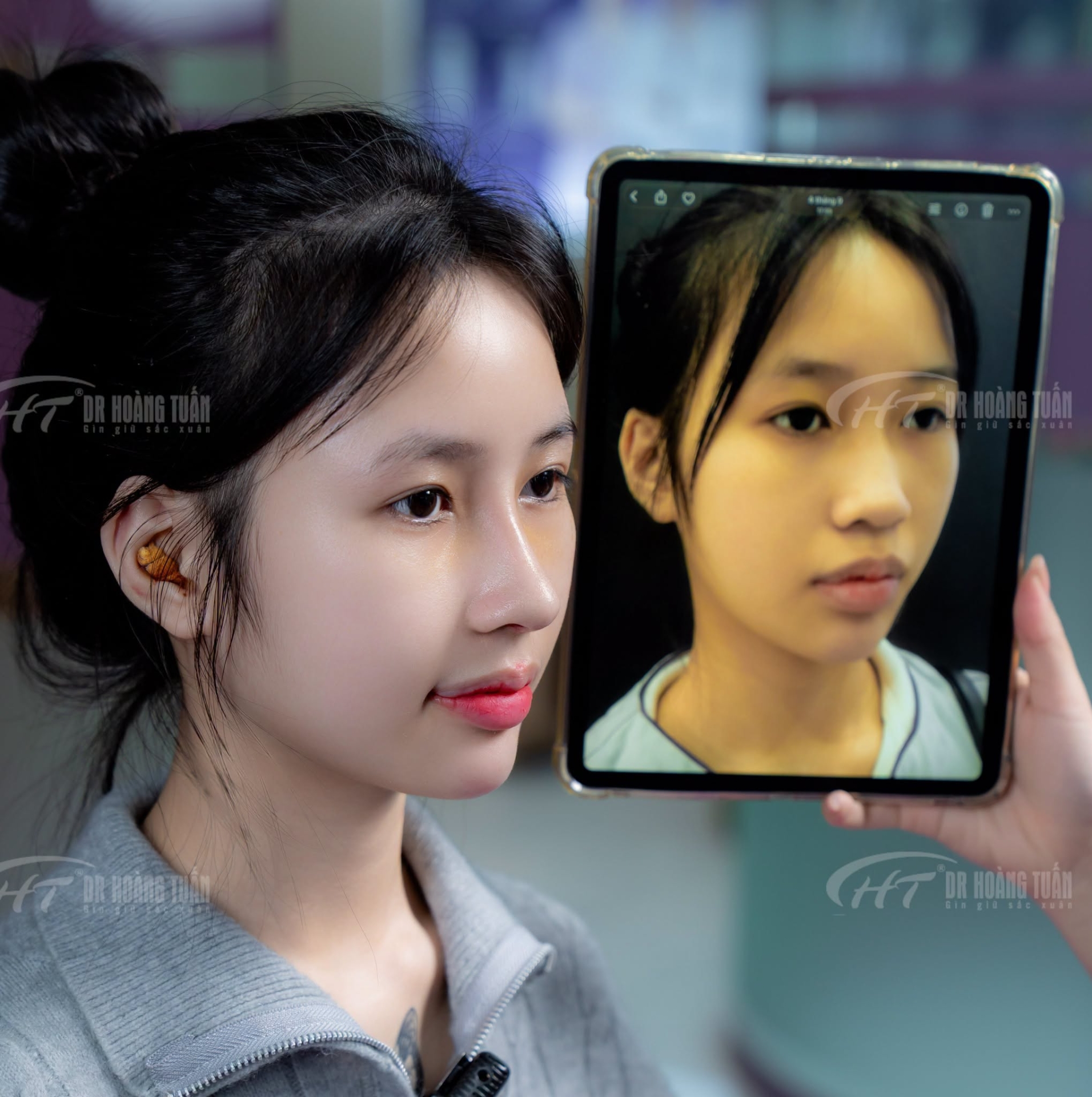 nâng mũi bao lâu thì tự gội đầu được