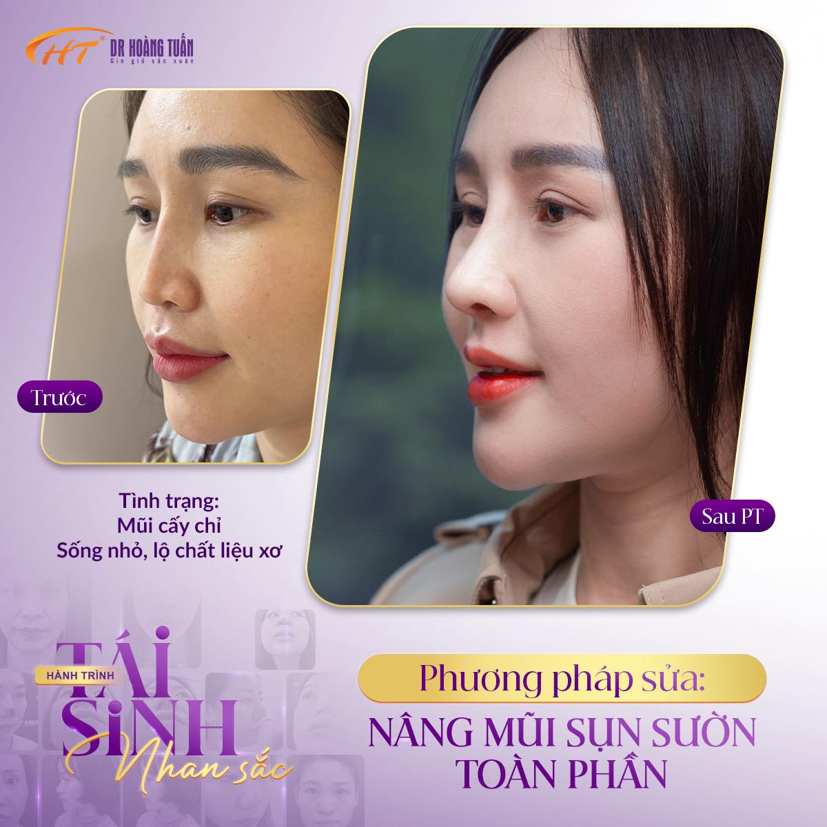 nâng mũi sụn sườn