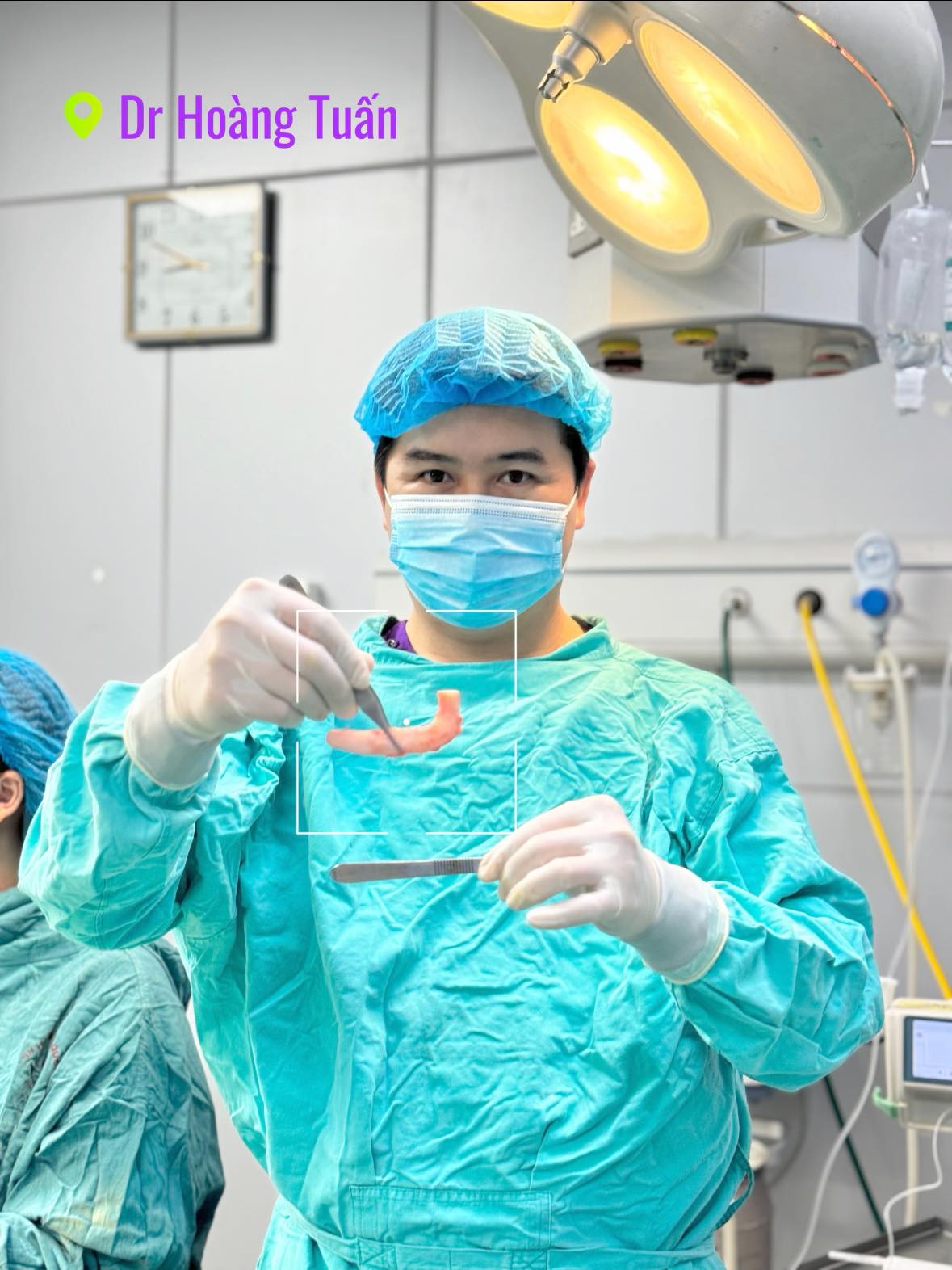 nâng mũi sụn sườn giữ được bao lâu