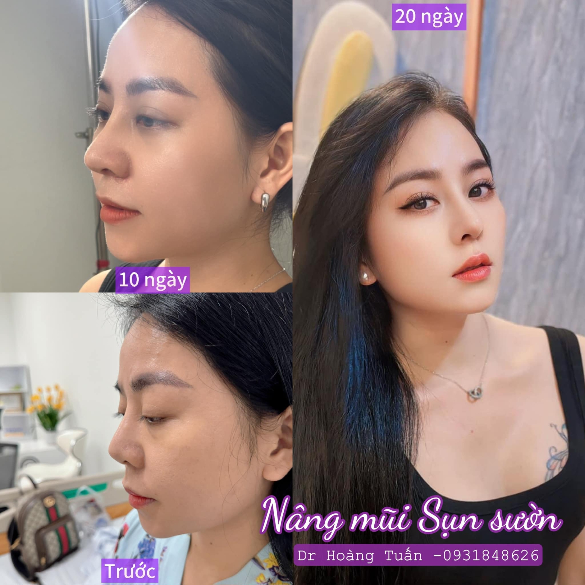 nâng mũi sụn sườn có tốt không