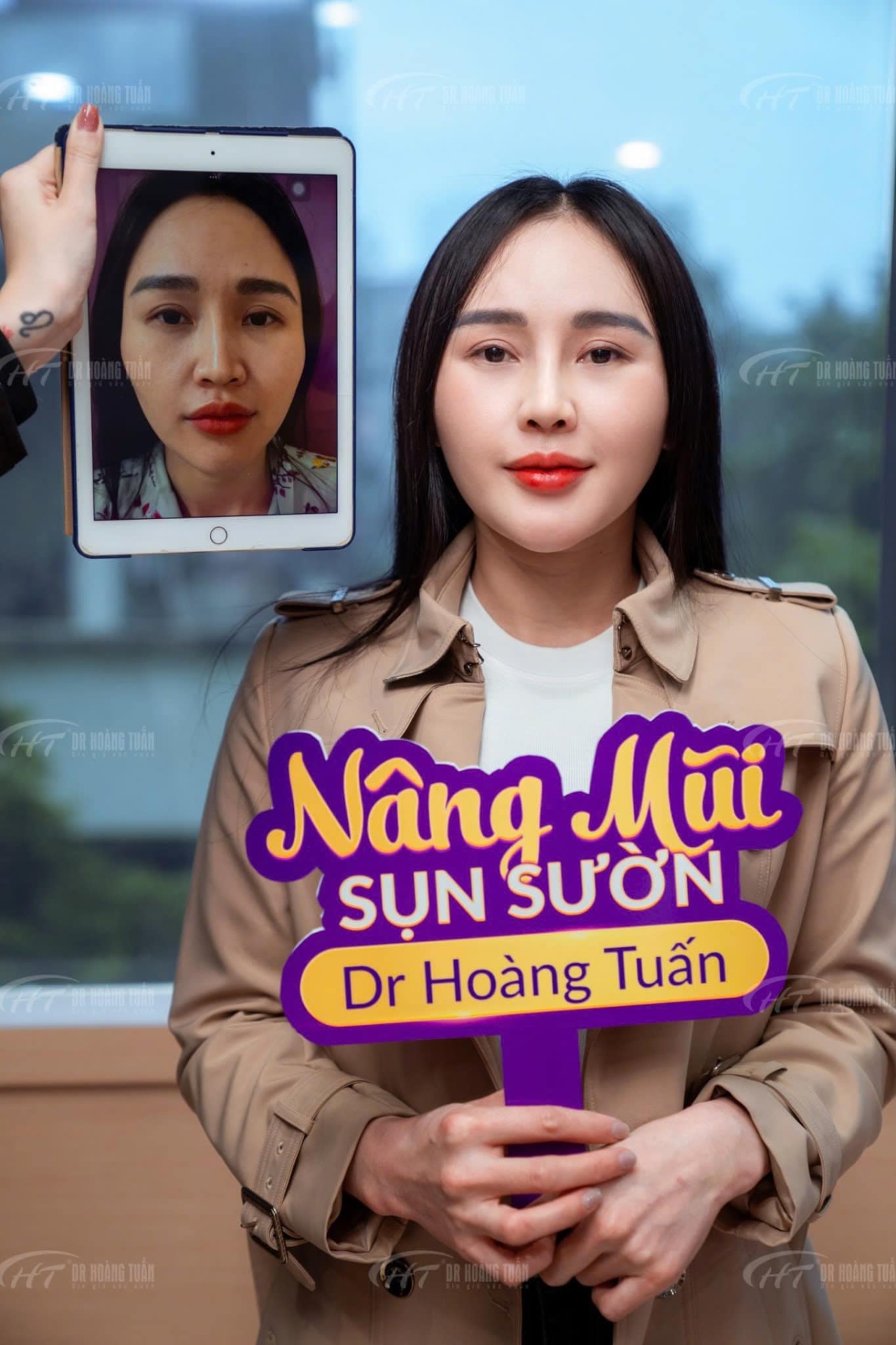 nâng mũi sụn sườn mất bao lâu