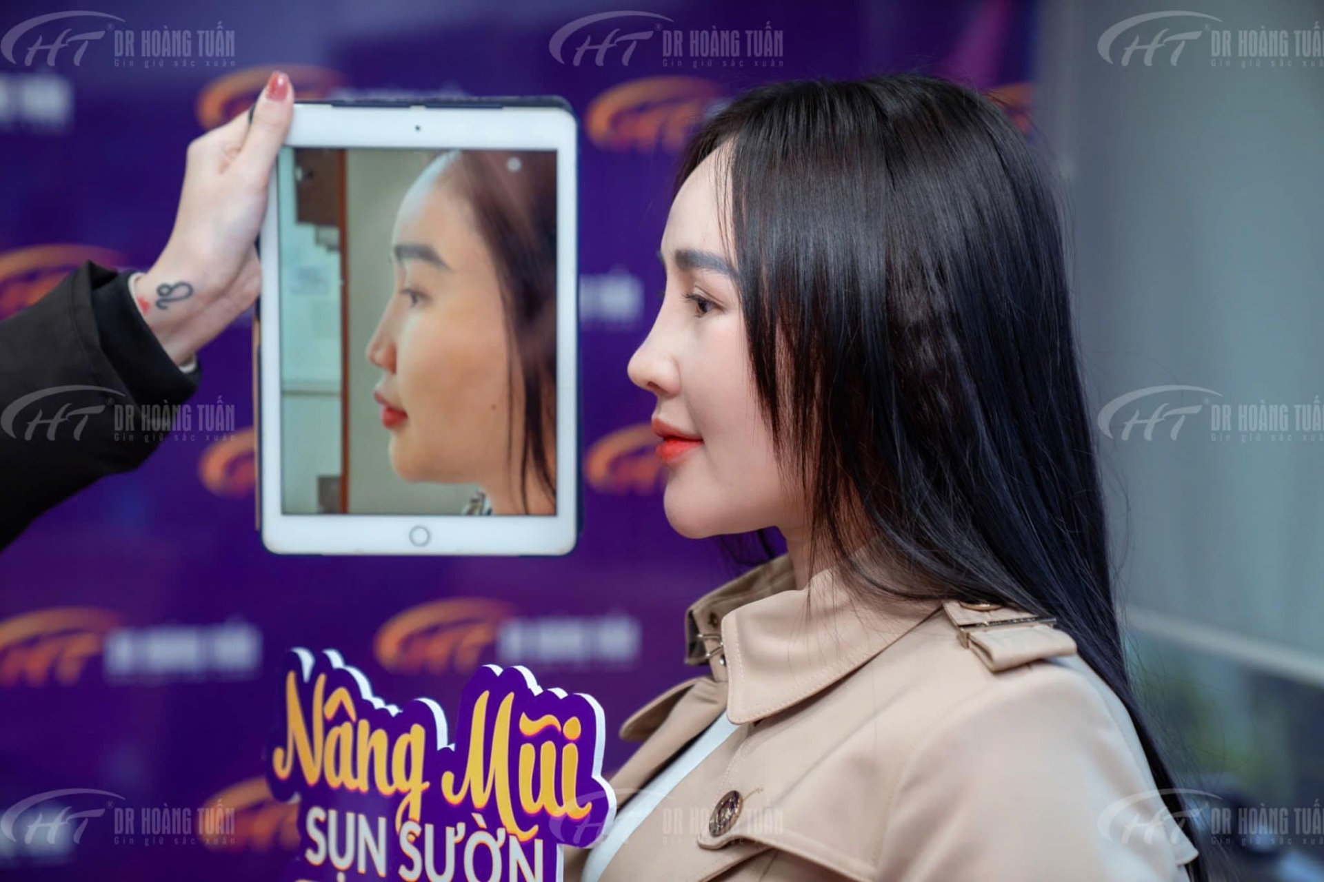 nâng mũi sụn sườn mất bao lâu