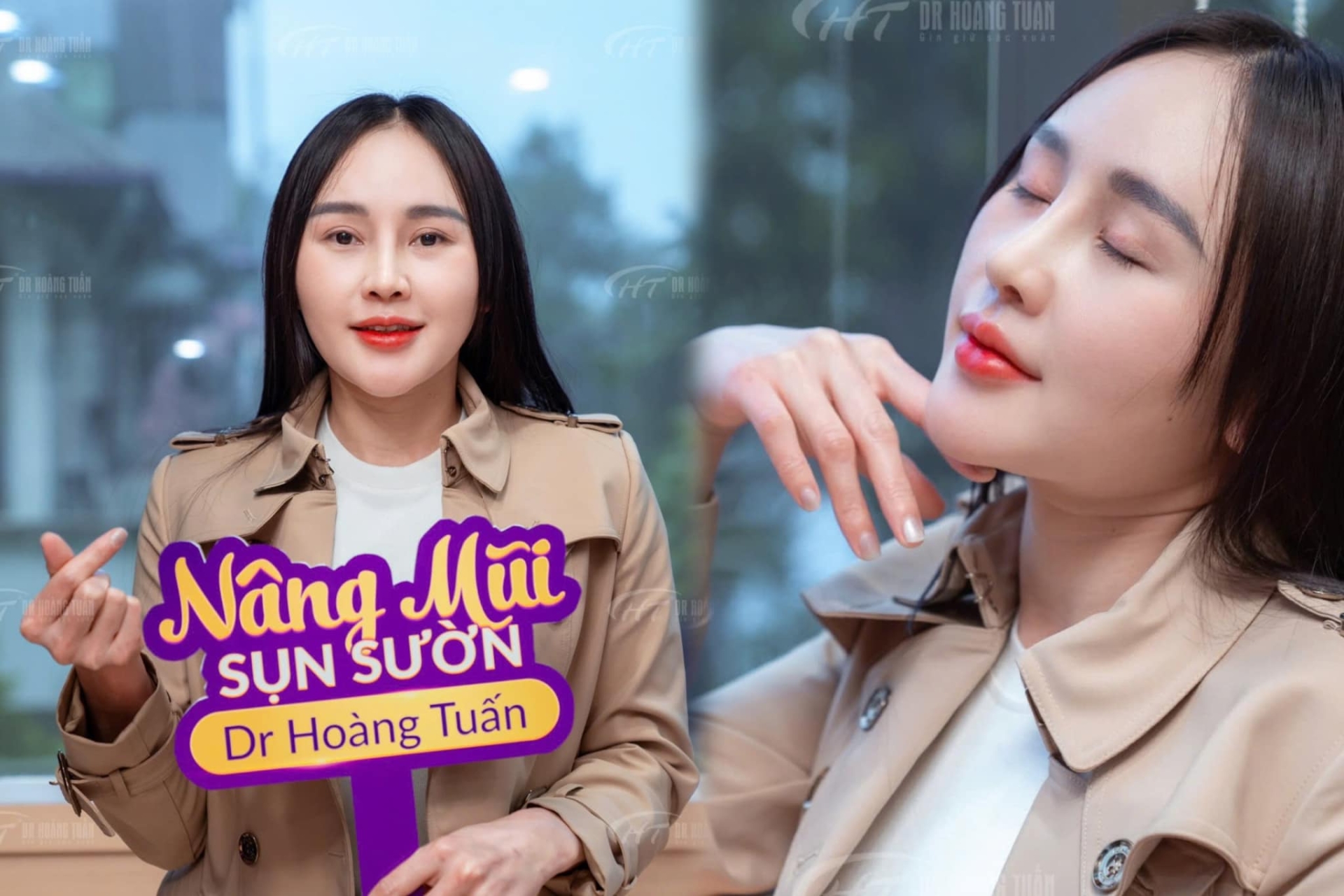 nâng mũi sụn sườn mất bao lâu