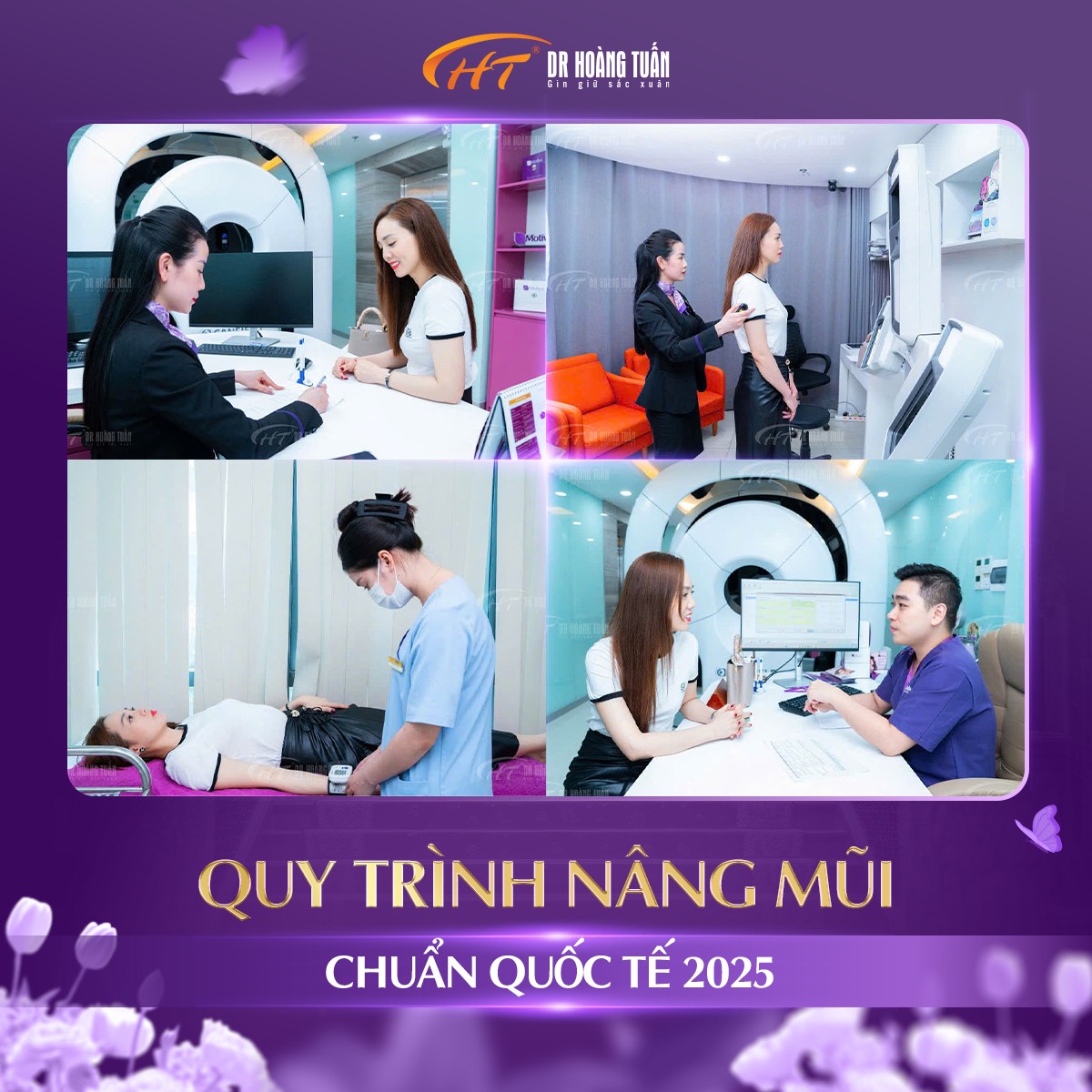 nâng mũi sụn sườn giữ được bao lâu