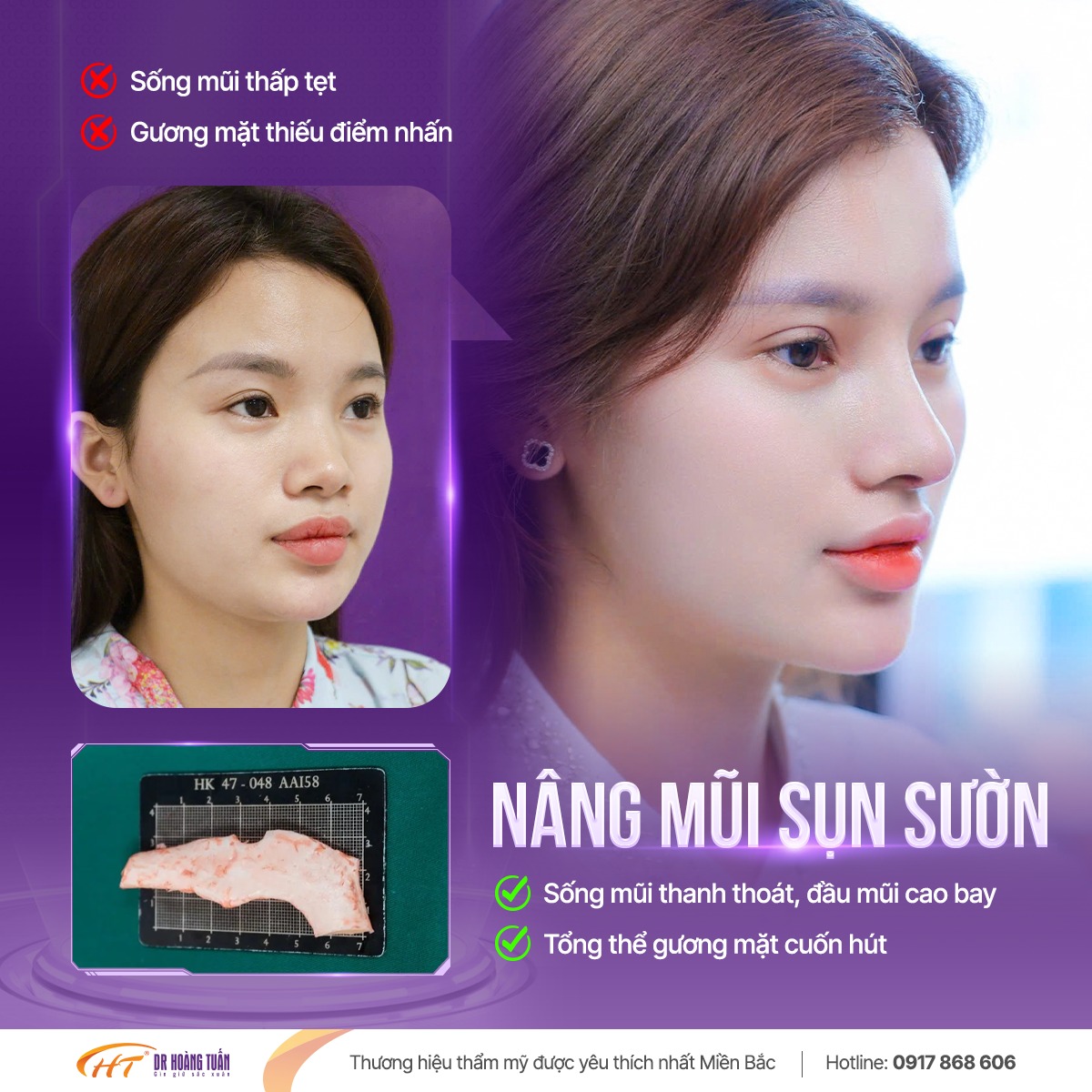 nâng mũi sụn sườn có bị teo lại không