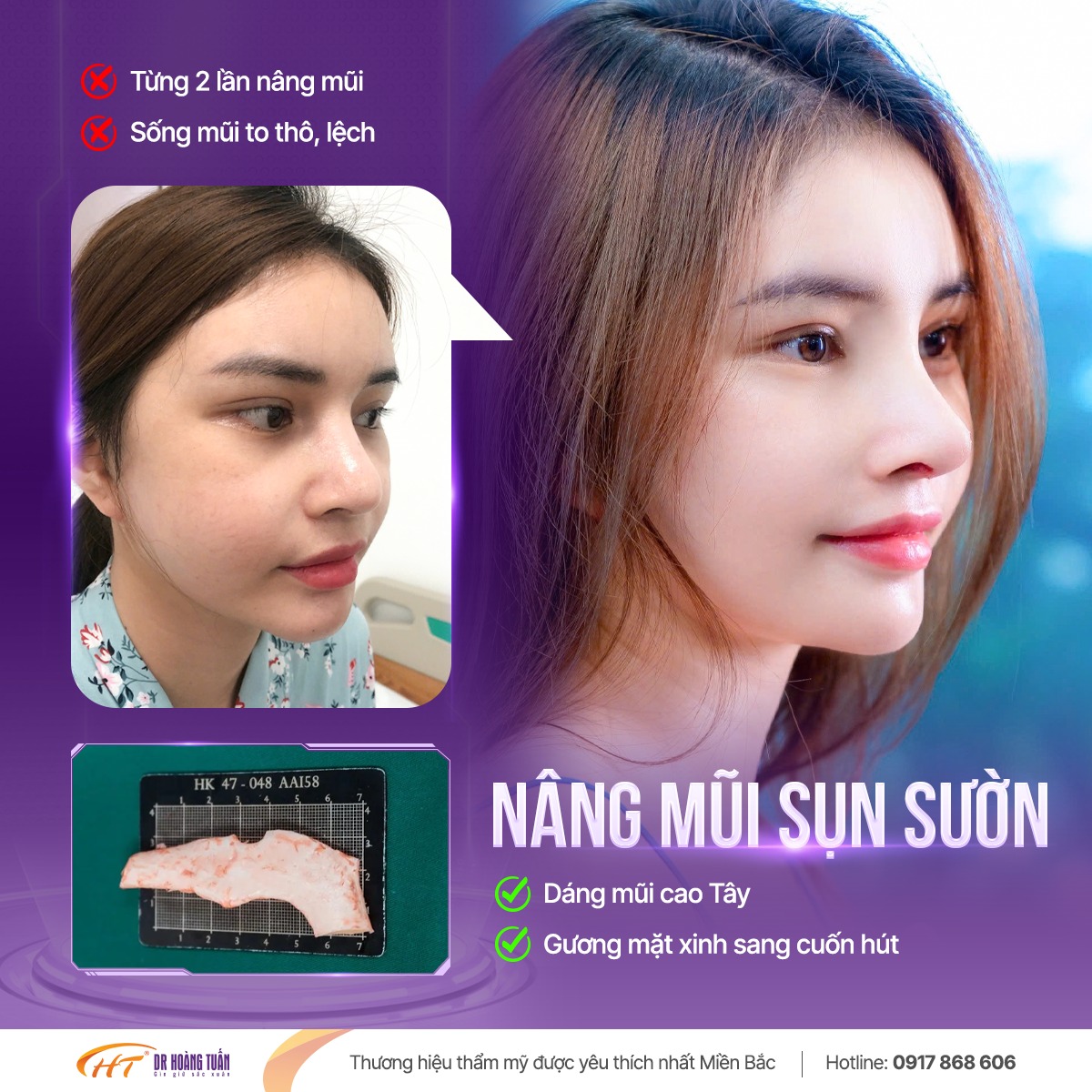 nâng mũi sụn sườn có bị teo lại không