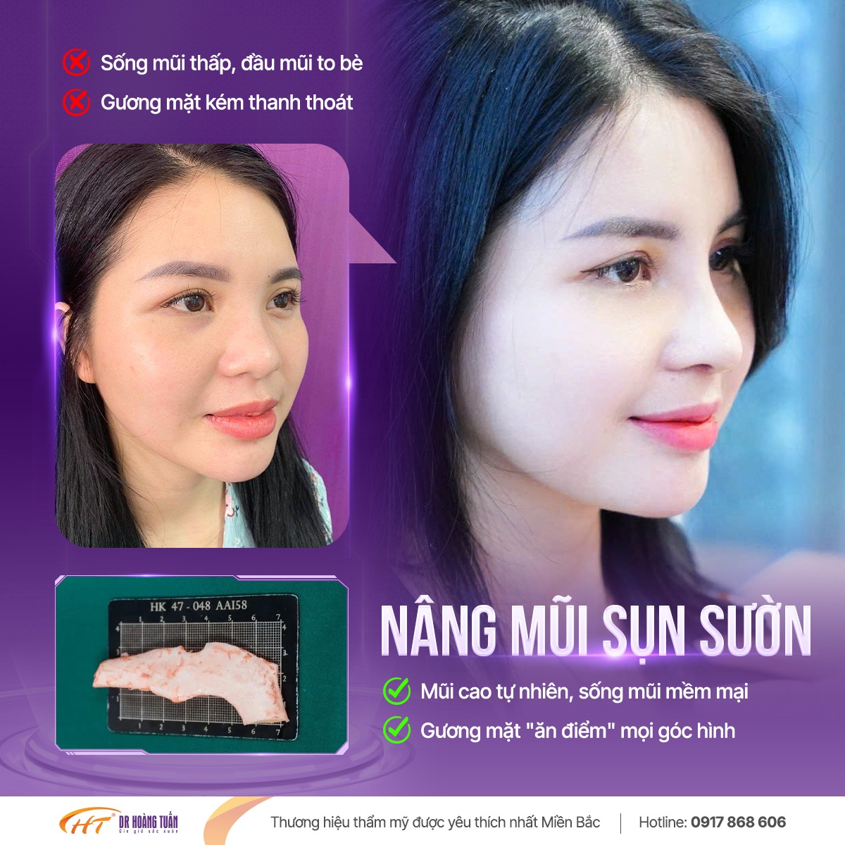 nâng mũi sụn sườn giữ được bao lâu
