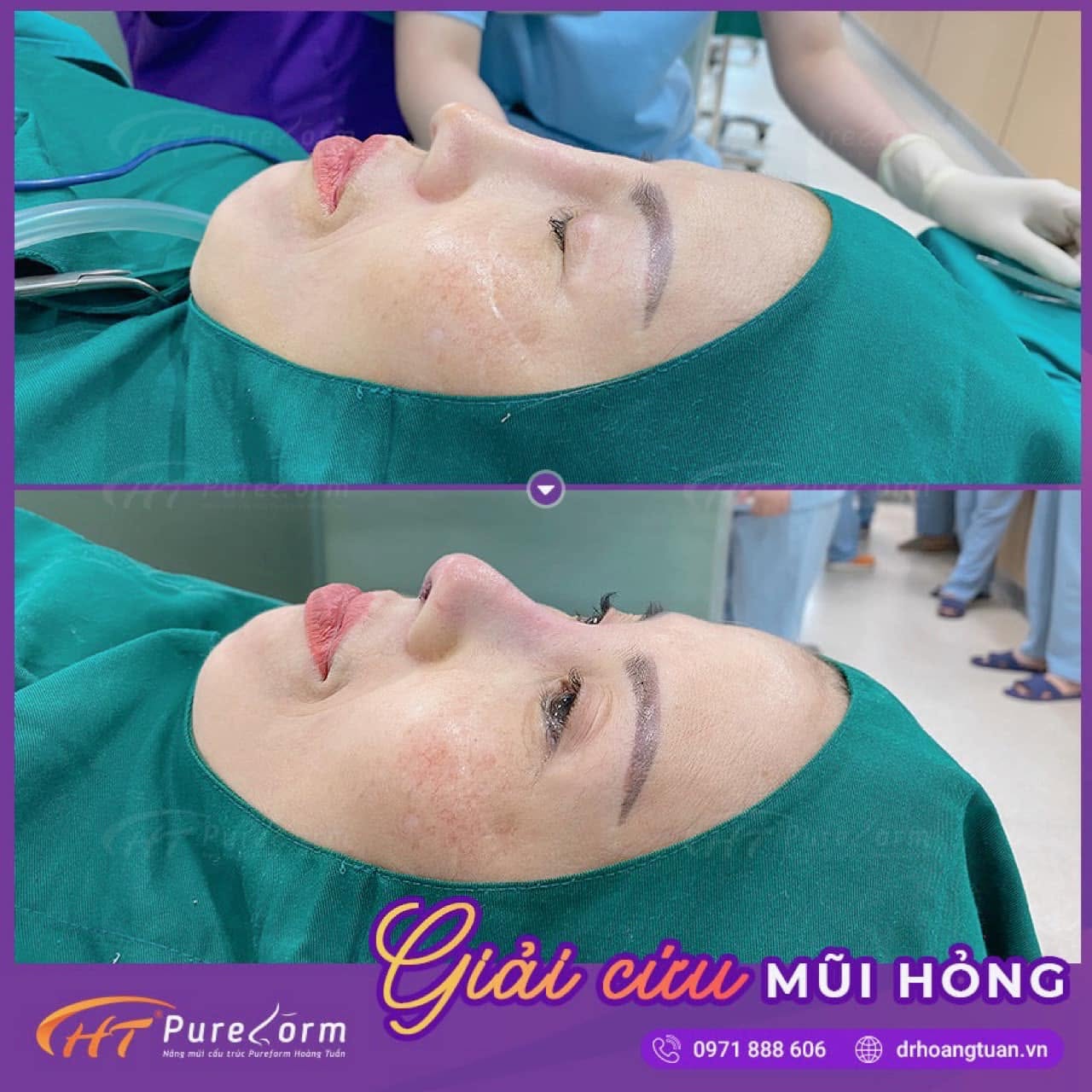 N&acirc;ng mũi bị lộ s&oacute;ng