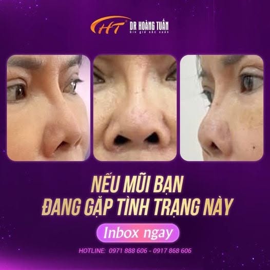 n&acirc;ng mũi hếch