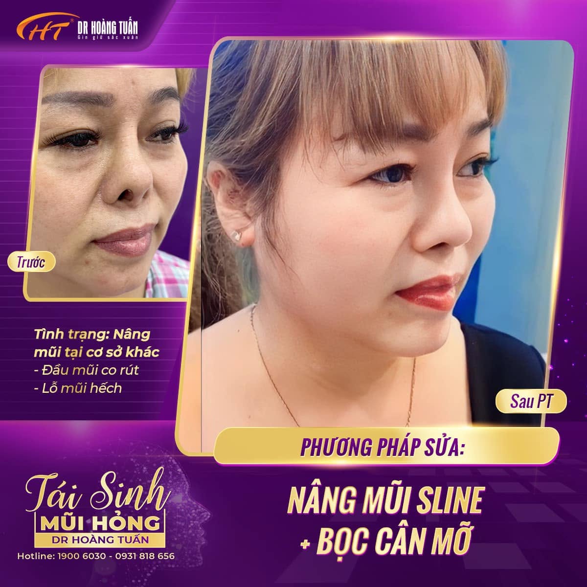 n&acirc;ng mũi hếch