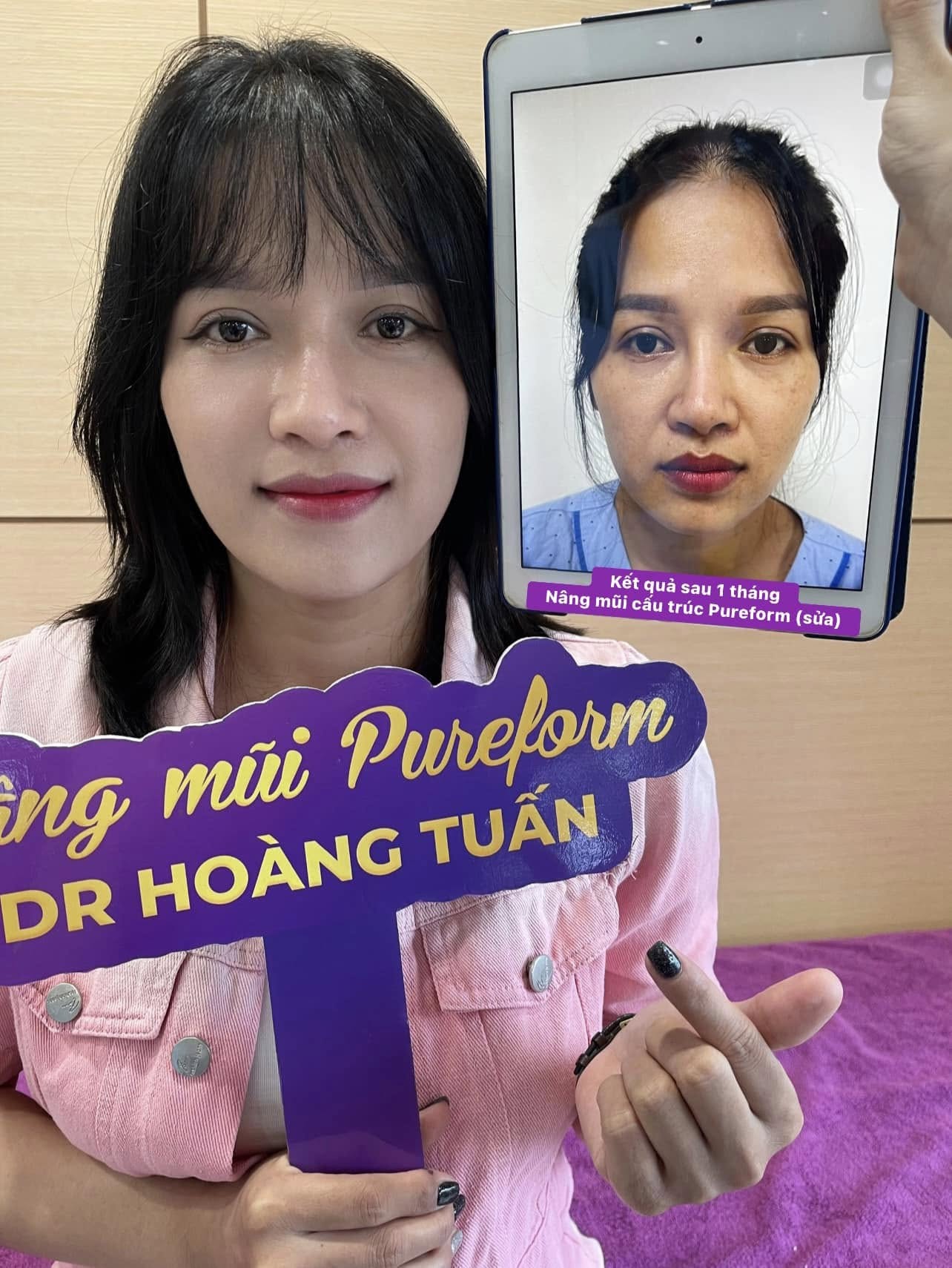 N&acirc;ng mũi bị lộ s&oacute;ng