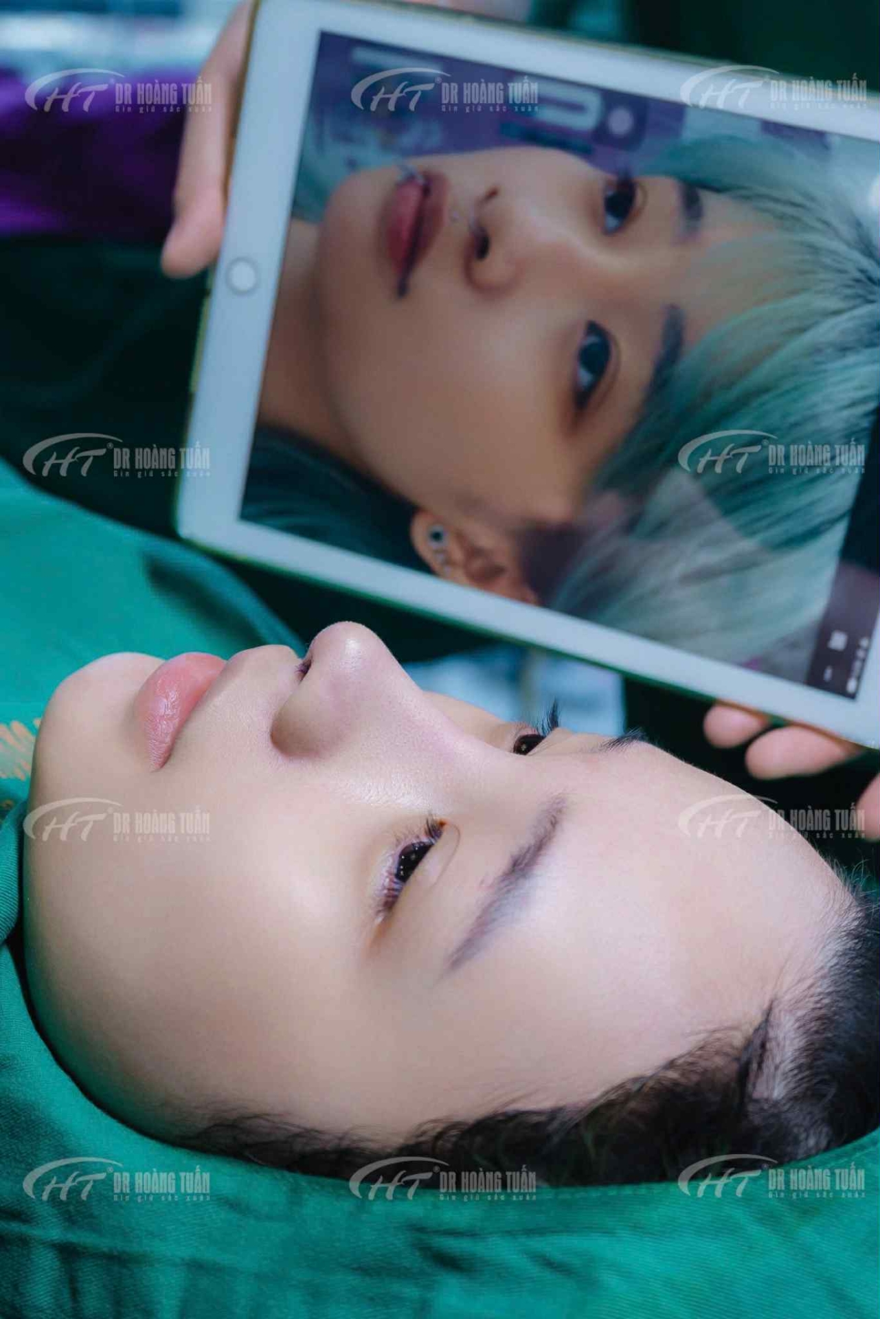 n&acirc;ng mũi bằng chỉ c&oacute; an to&agrave;n kh&ocirc;ng