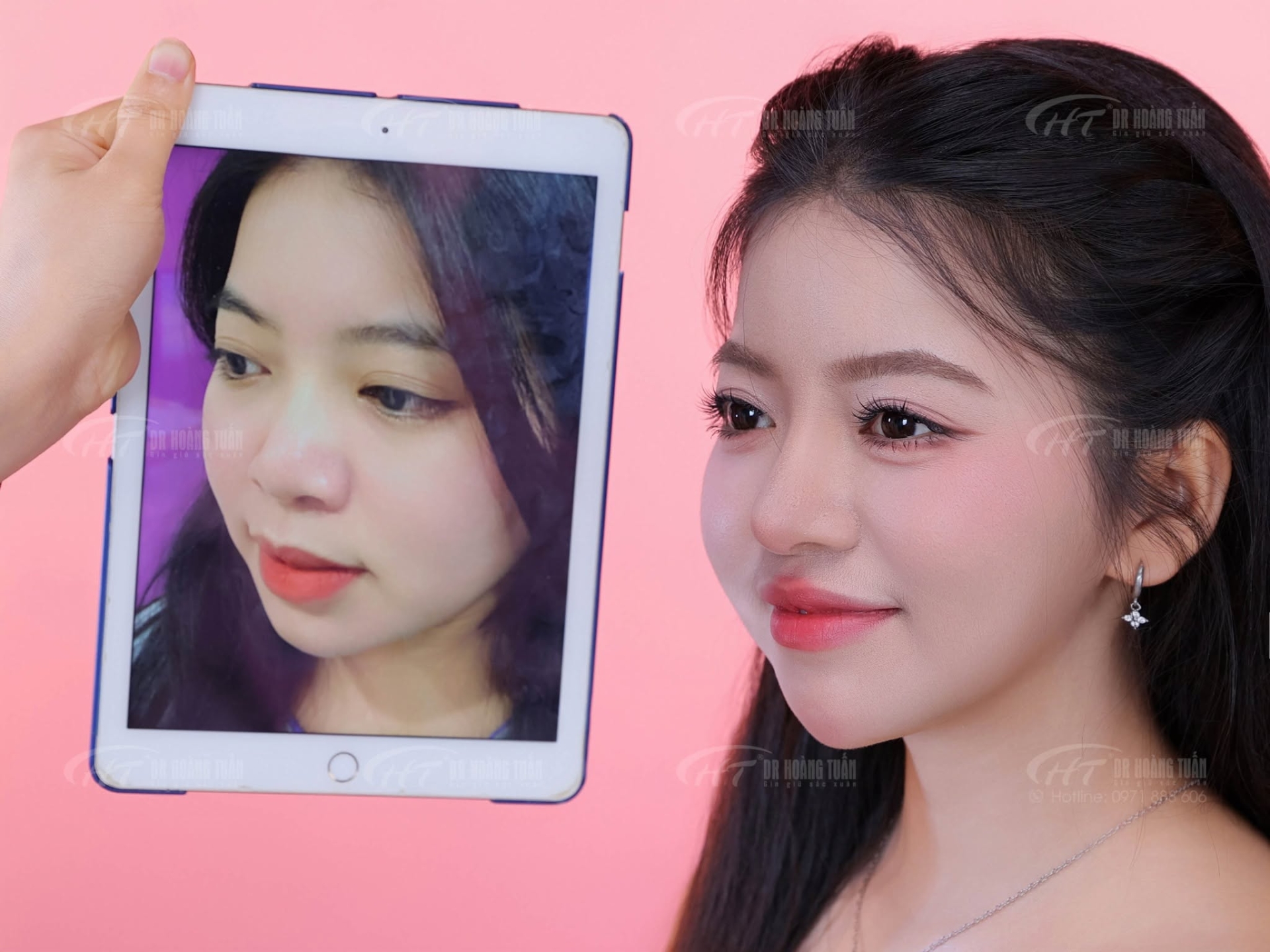 lưu &yacute; khi n&acirc;ng mũi