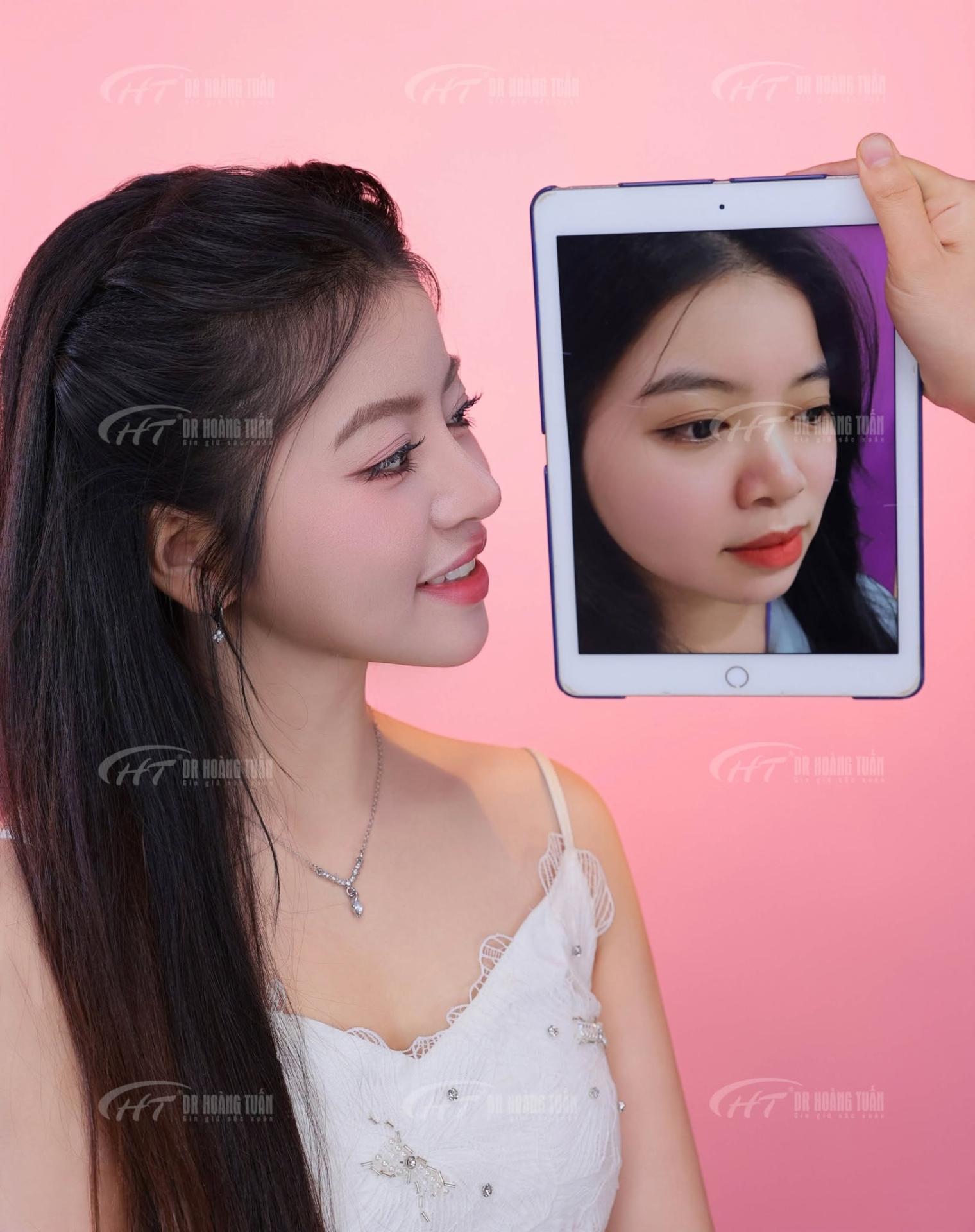 n&acirc;ng mũi hếch