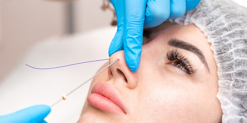 n&acirc;ng mũi bằng chỉ c&oacute; an to&agrave;n kh&ocirc;ng