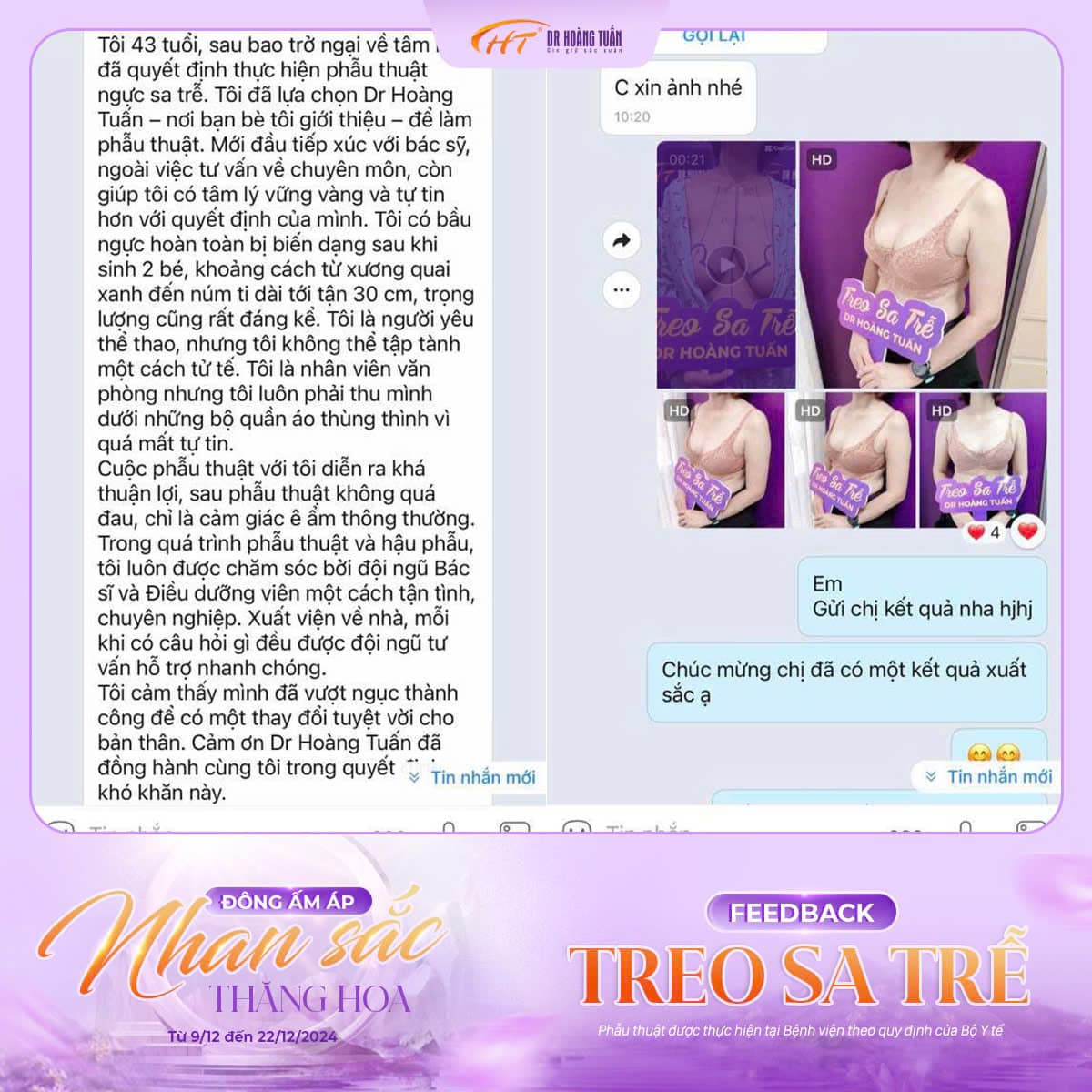 treo ngực sa trễ giữ được bao lâu