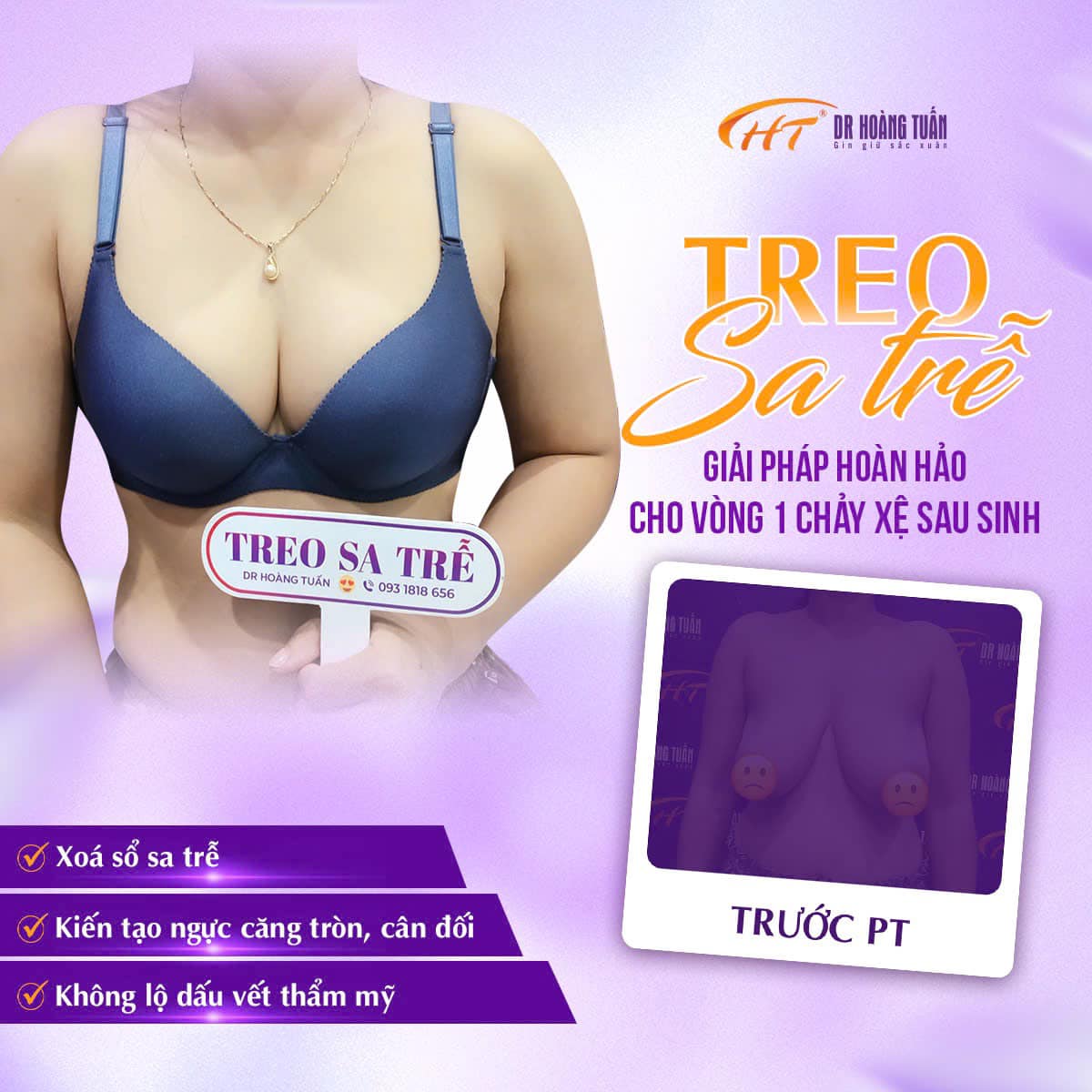 có nên treo ngực sa trễ