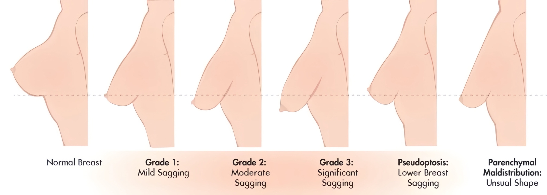 các phương pháp treo ngực sa trễ