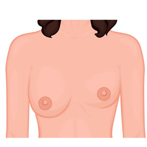 nâng ngực 1 bên to 1 bên nhỏ