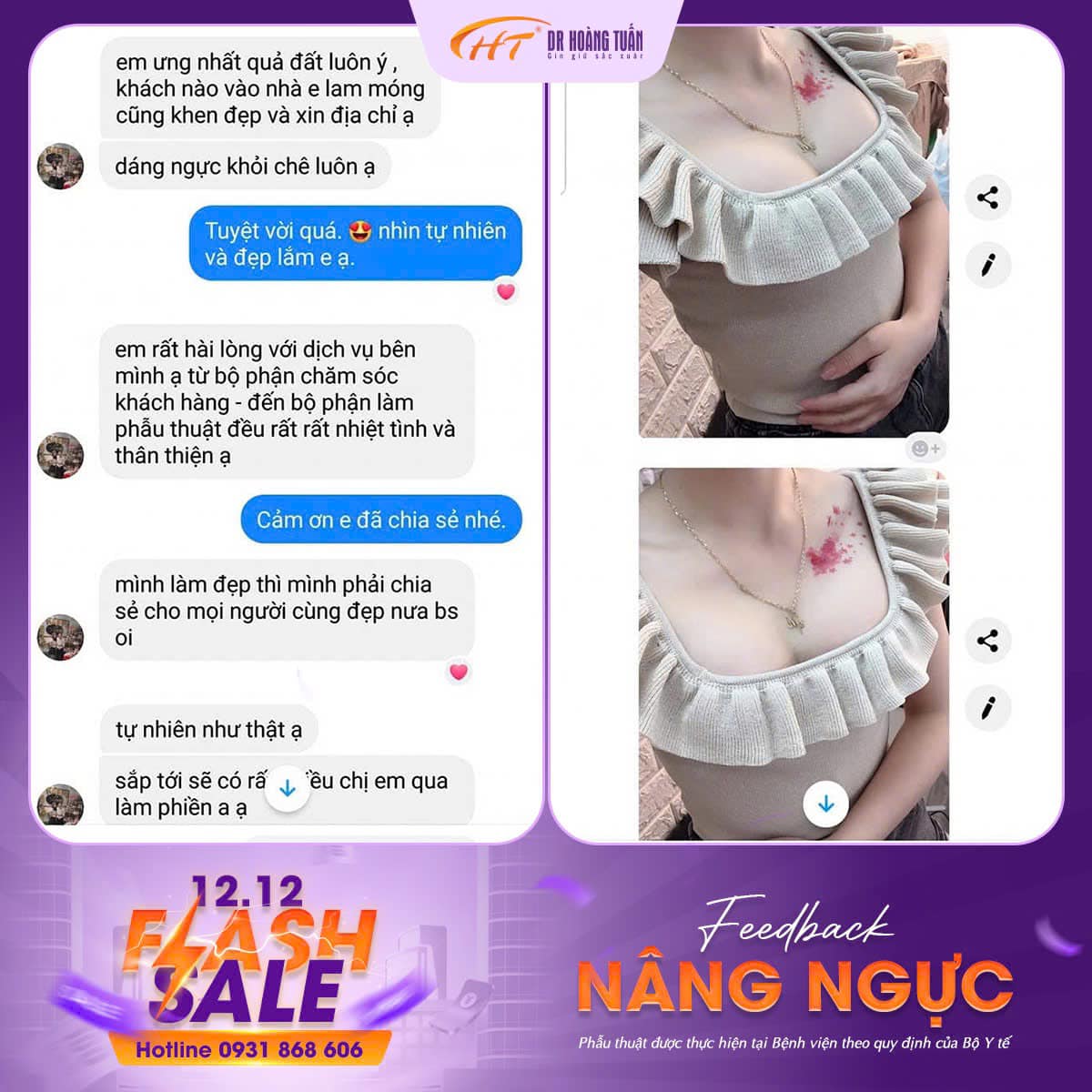 feedback nâng ngực