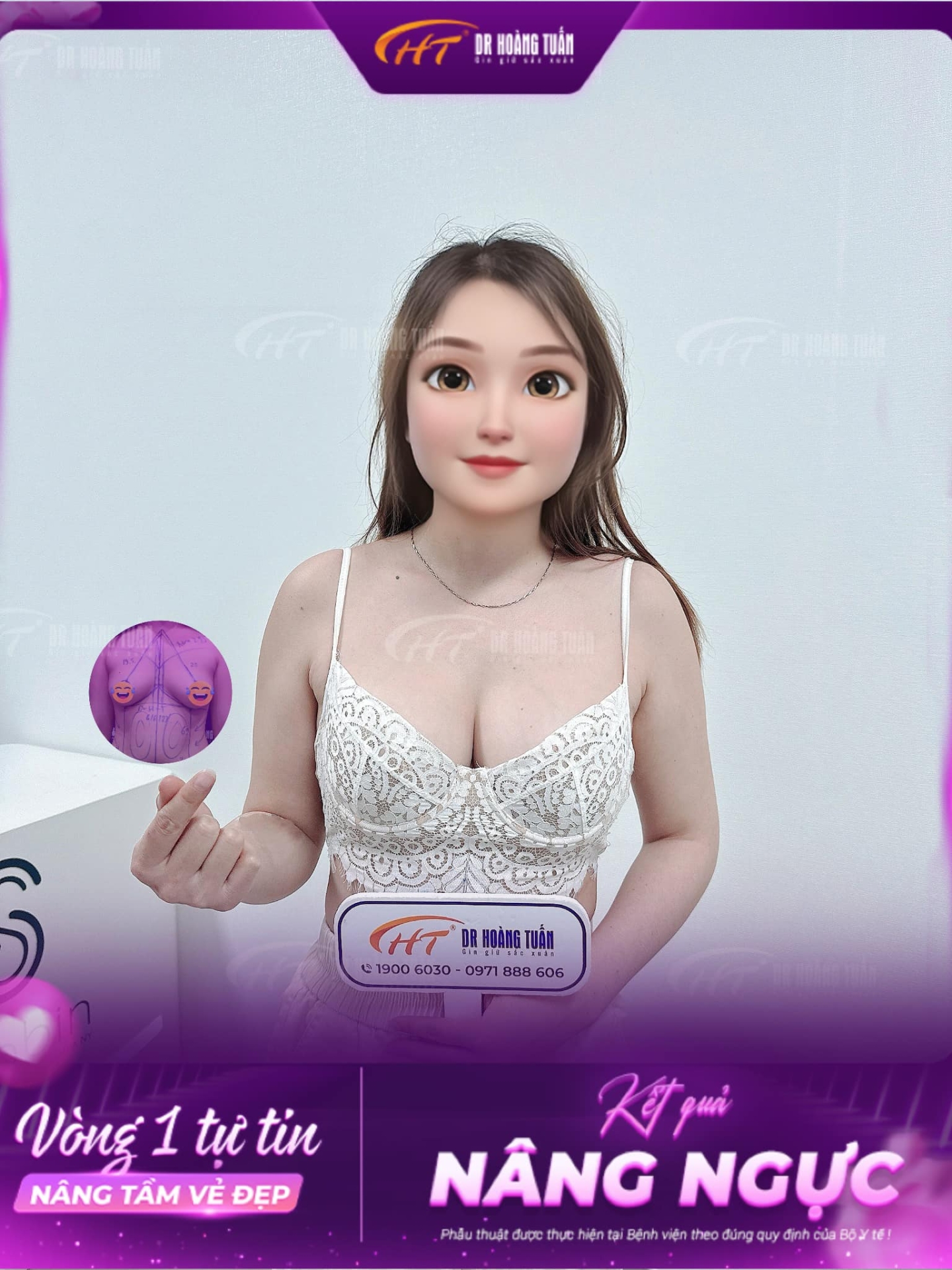 quá trình nâng ngực