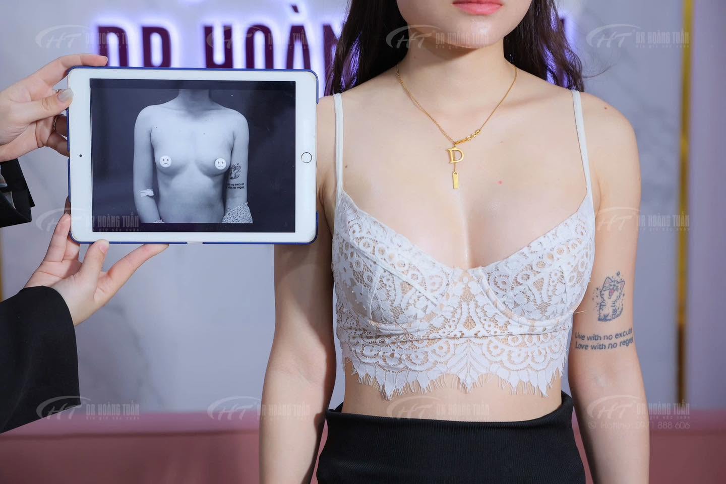 nâng ngực lép