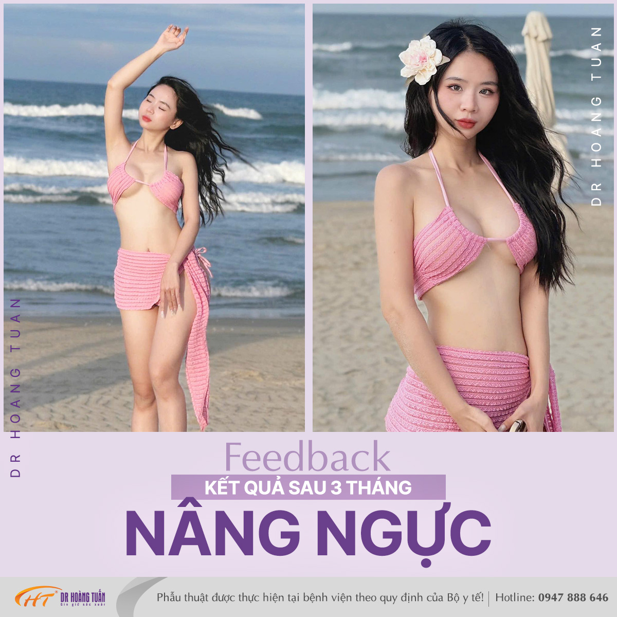 Chuyên gia nói gì? Có nên thả rông sau nâng ngực?