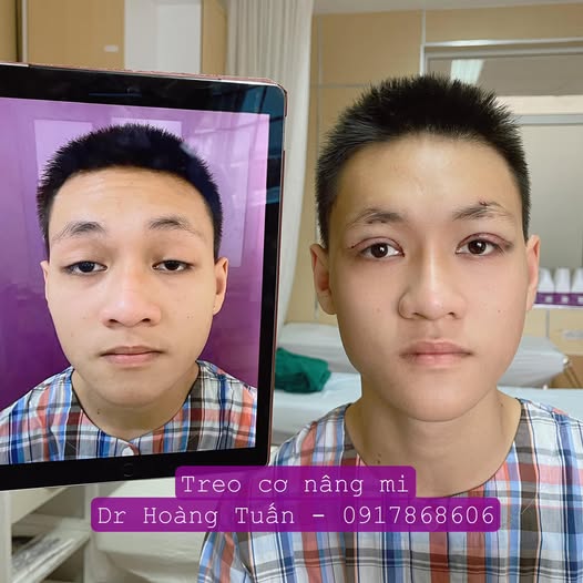 nhấn mí bị sụp