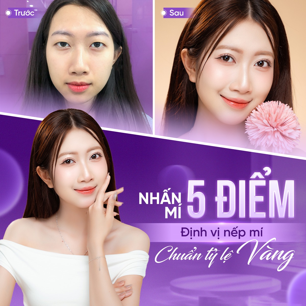 nhấn mí bao nhiêu ngày hết sưng