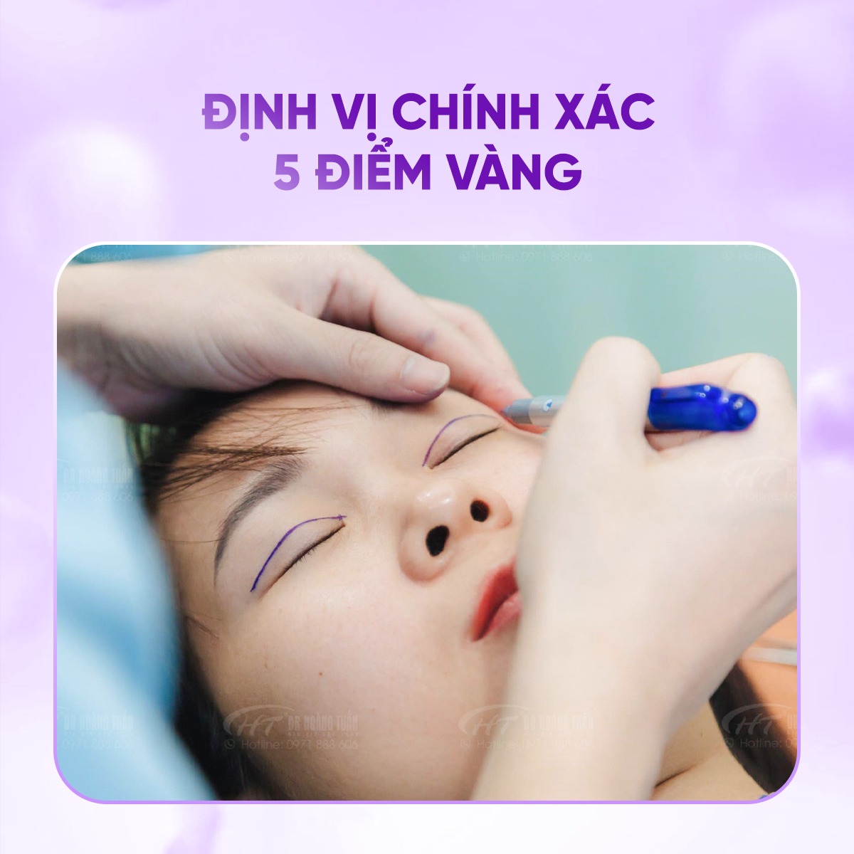 nhấn mí có sẹo không