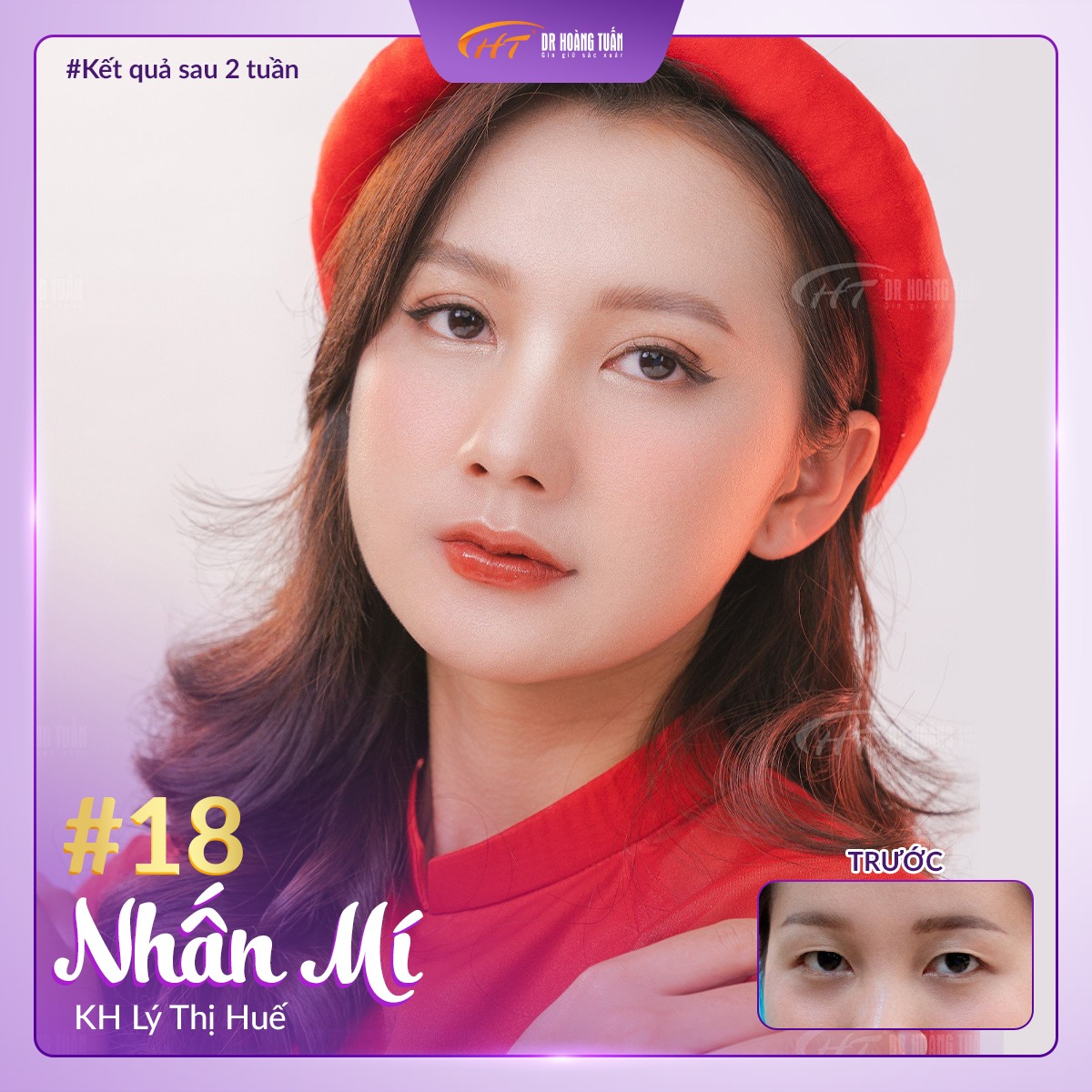 phẫu thuật thẩm mỹ mắt ở đâu tốt nhất