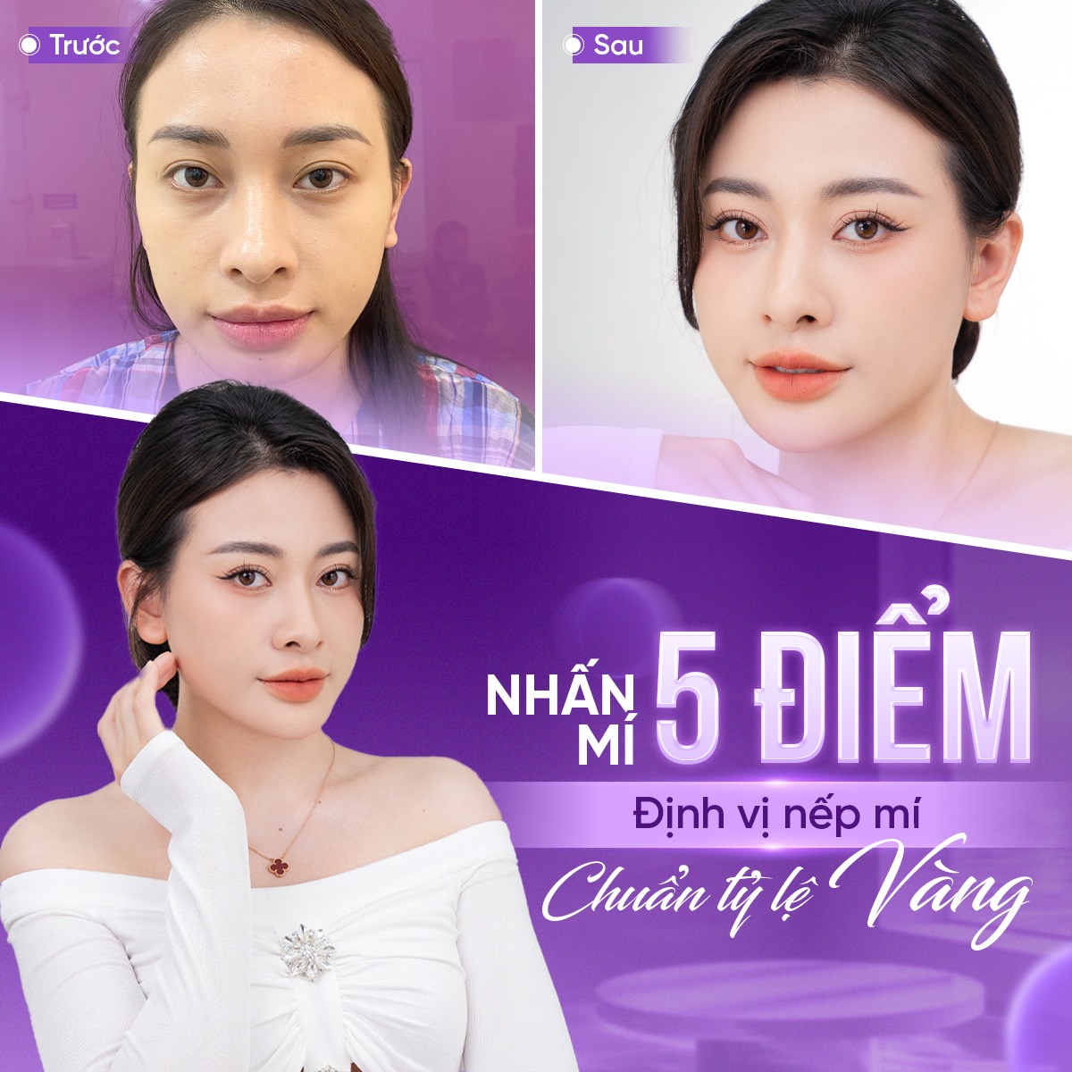 nhấn mí bao nhiêu ngày hết sưng