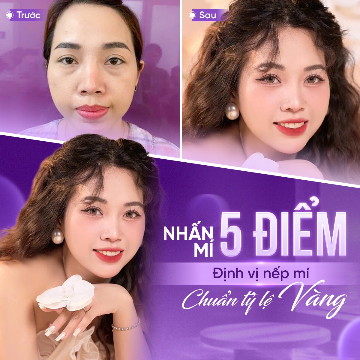 nhấn mí bao nhiêu ngày hết sưng