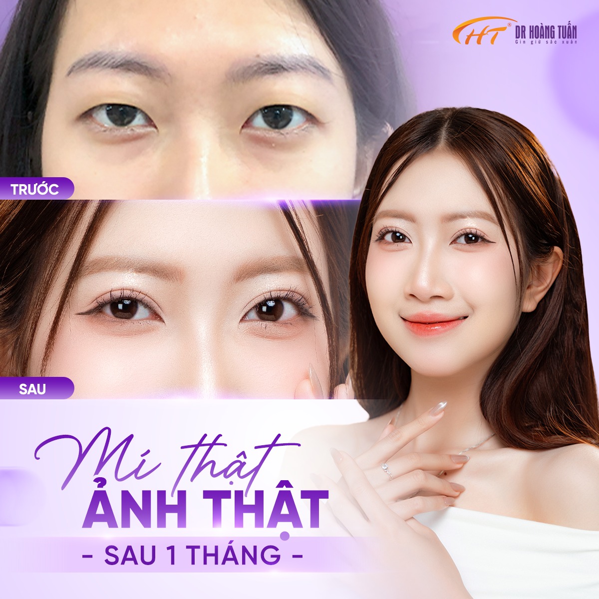 nhấn mí đau không