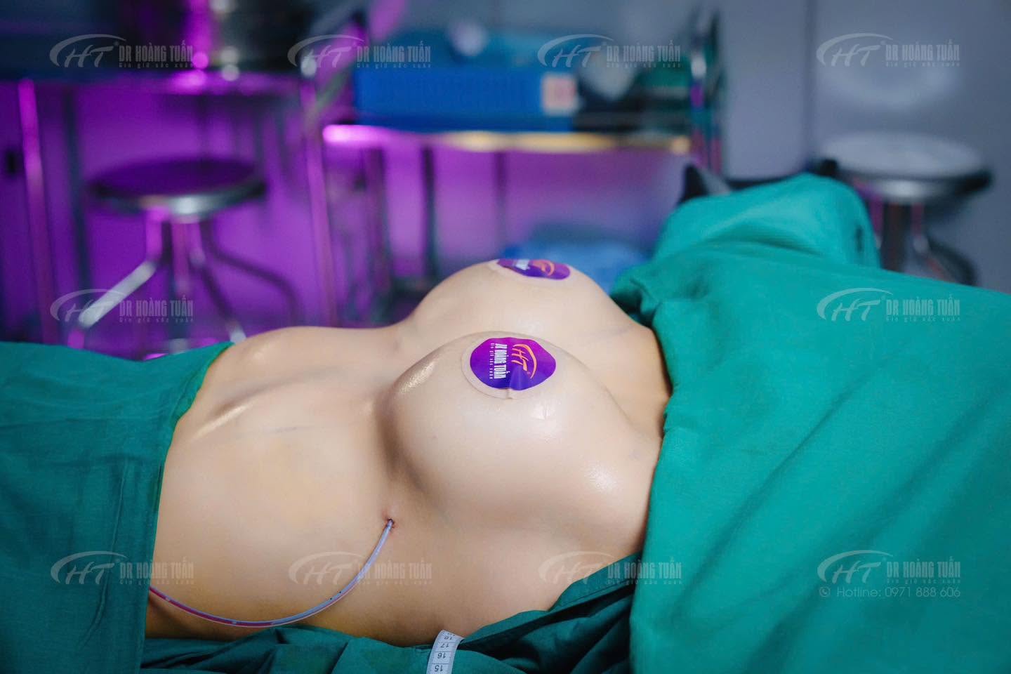 nâng ngực mặc áo định hình trong bao lâu