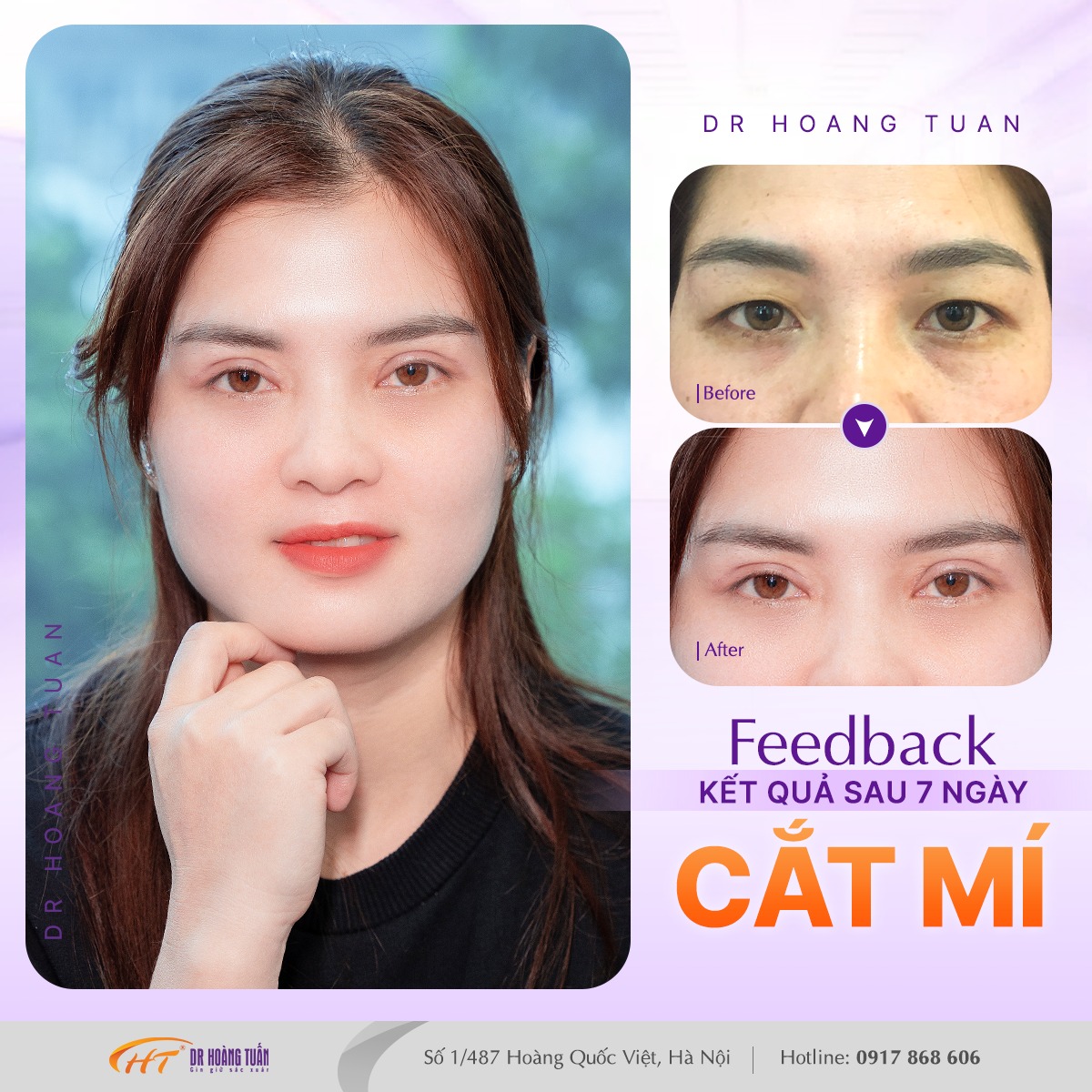 phẫu thuật thẩm mỹ mắt to có an toàn không