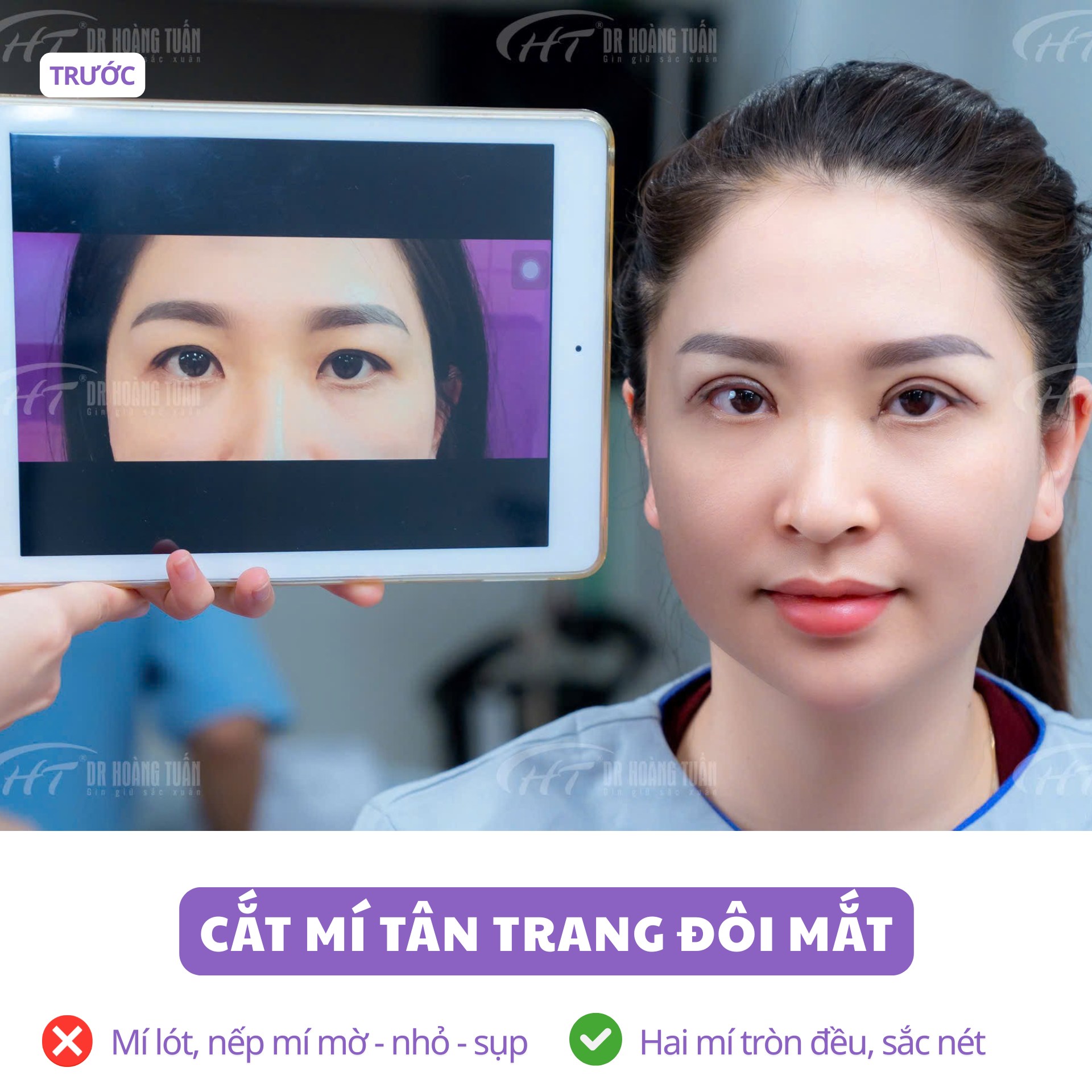 phẫu thuật thẩm mỹ cắt mí mắt