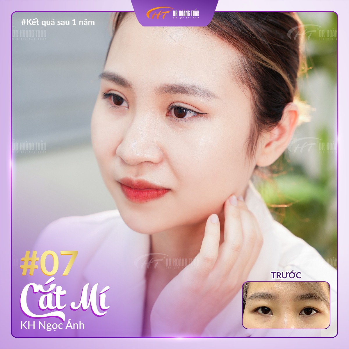 phẫu thuật thẩm mỹ cắt mí mắt