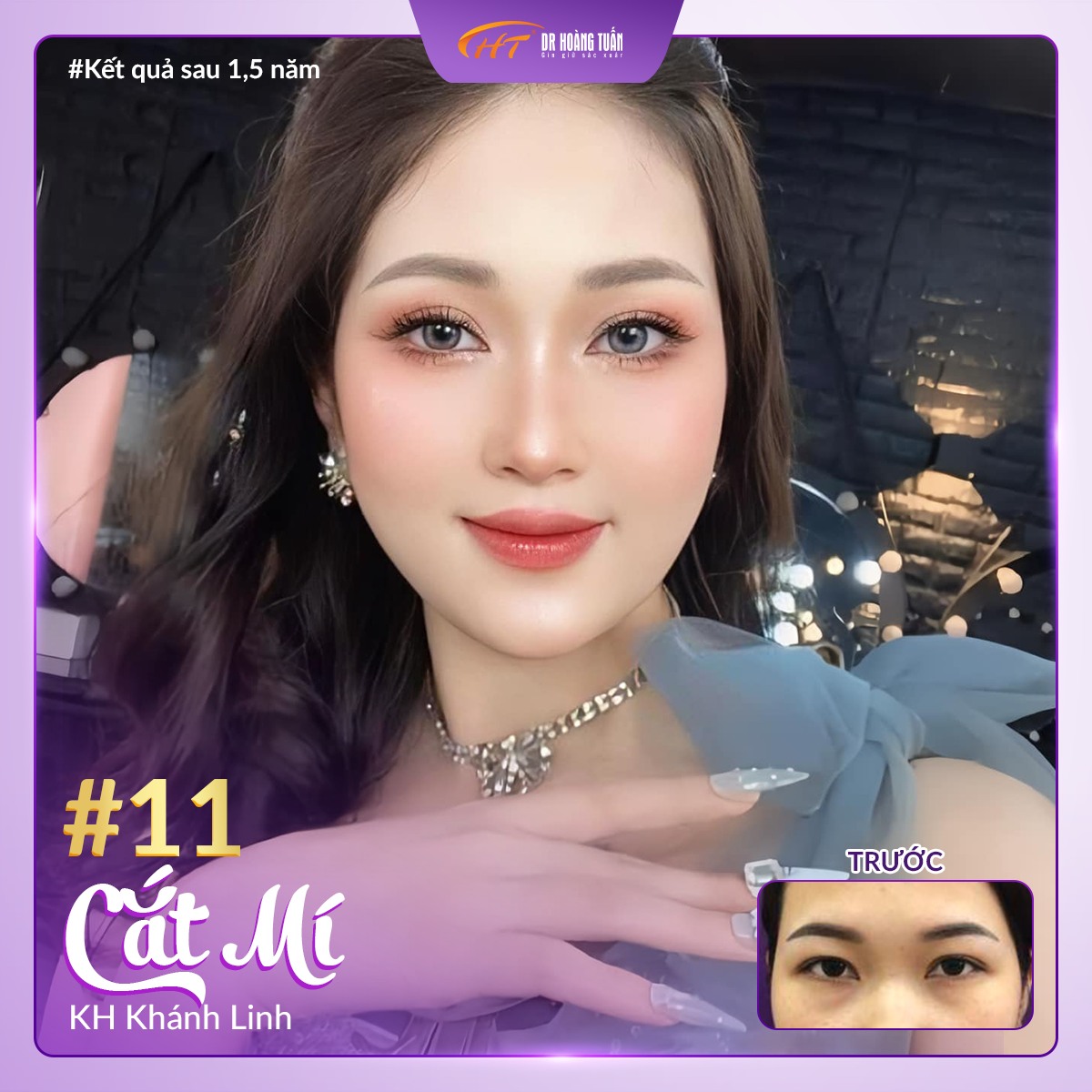 phẫu thuật thẩm mỹ cắt mí mắt