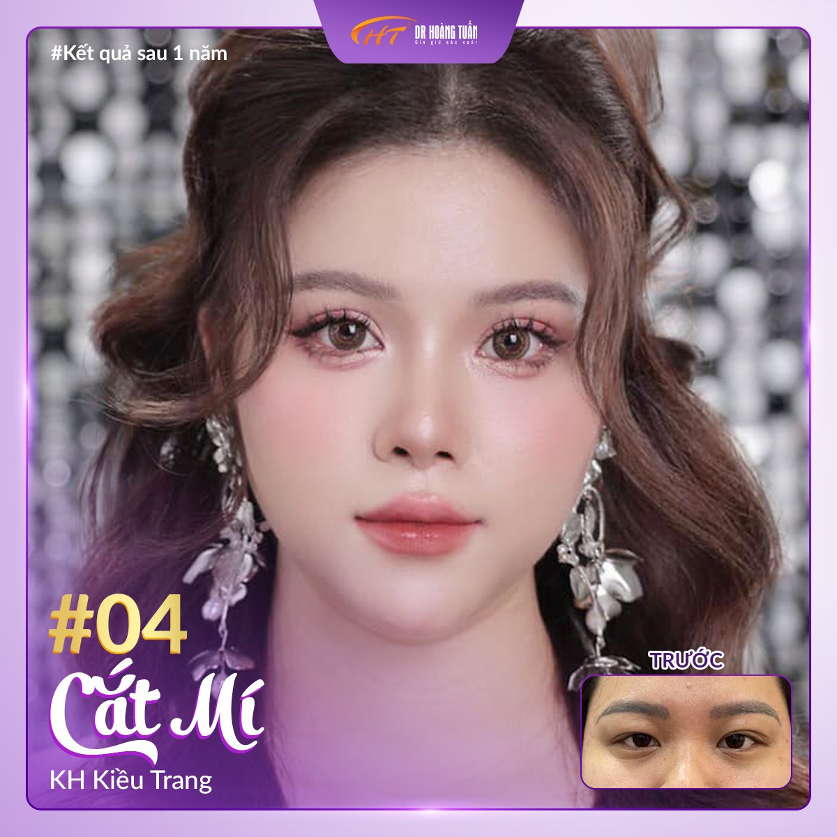 phẫu thuật thẩm mỹ cắt mí mắt