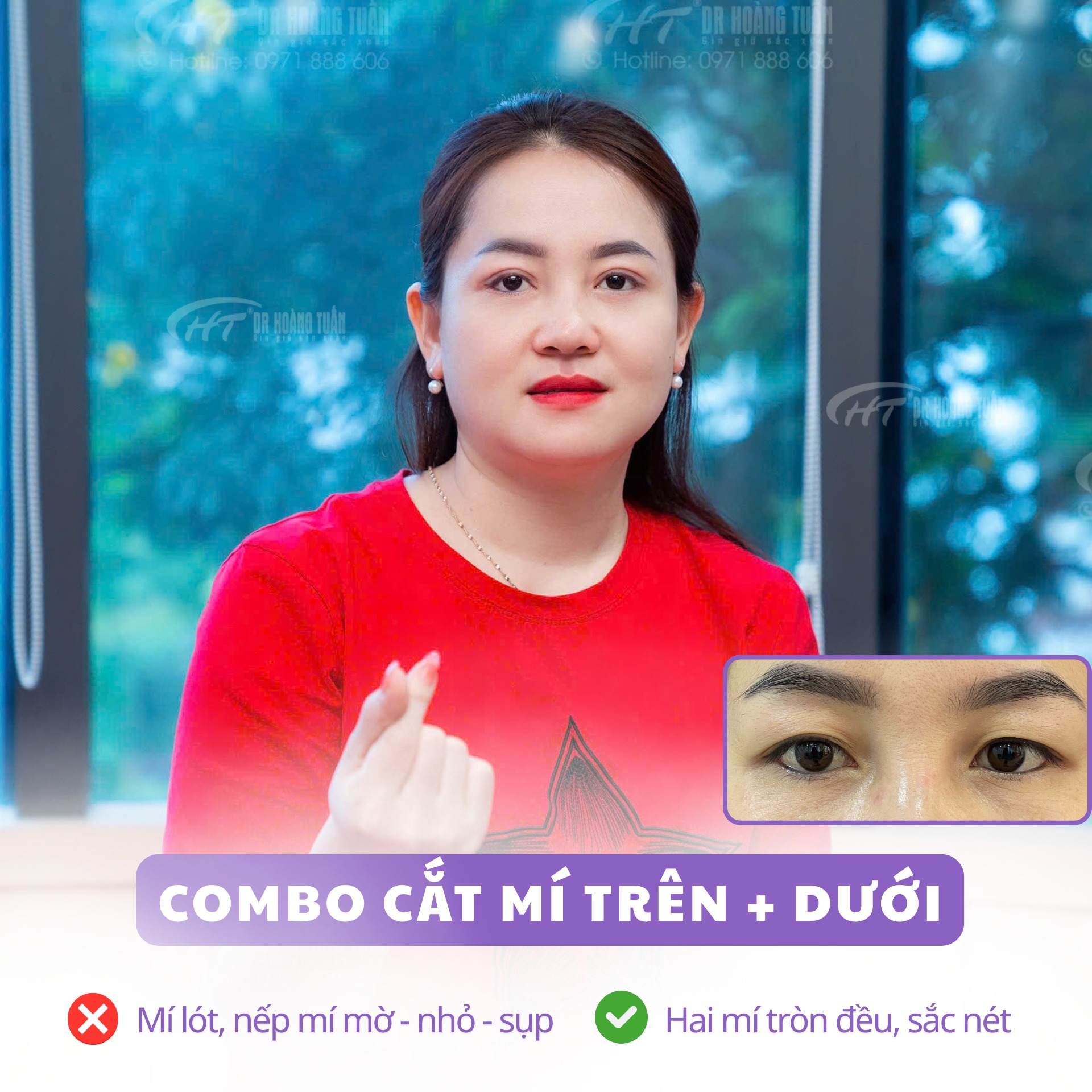 phẫu thuật thẩm mỹ mắt 2 mí