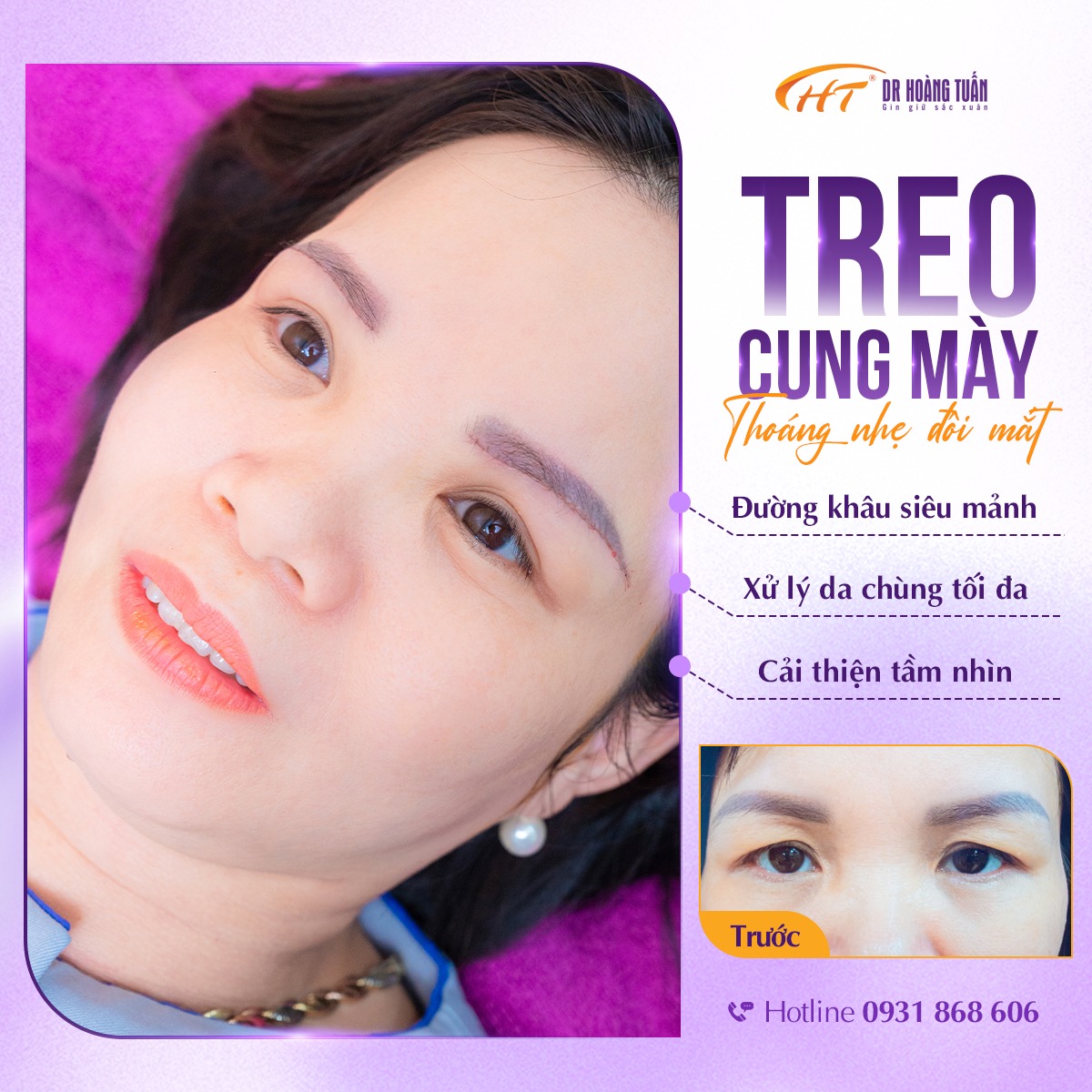 phẫu thuật thẩm mỹ mắt 2 mí