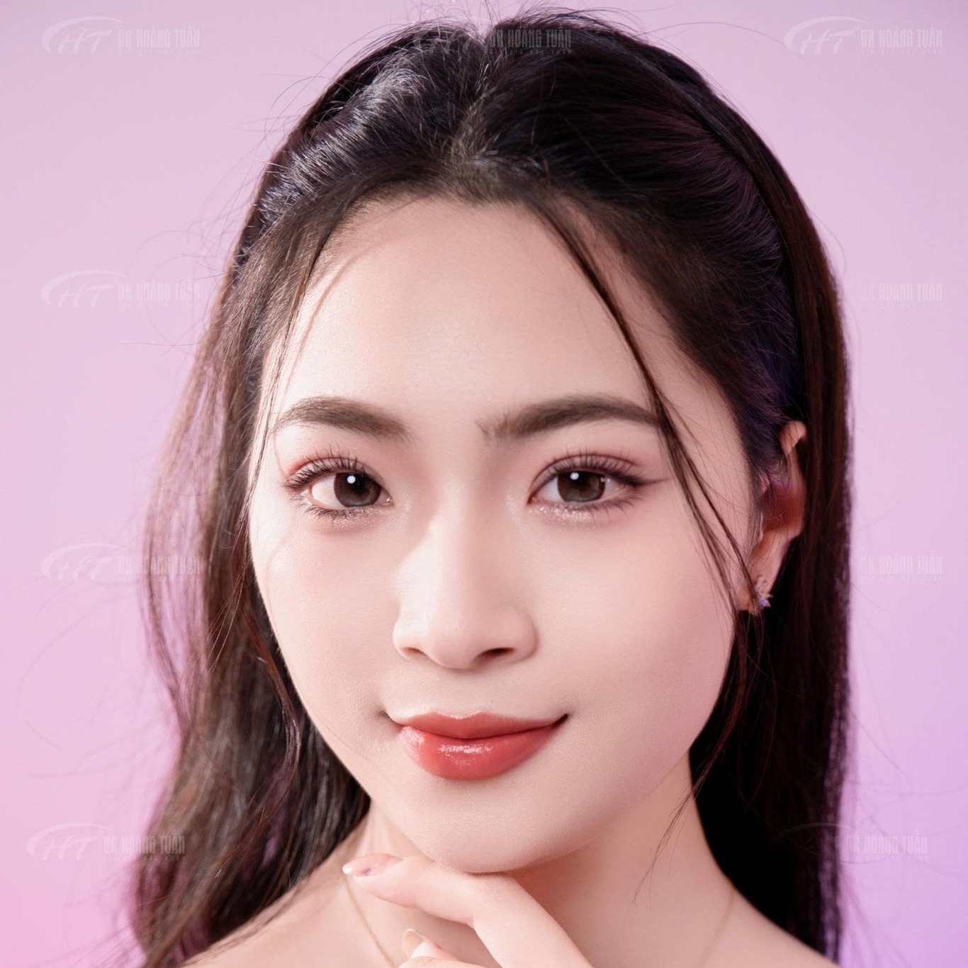 phẫu thuật thẩm mỹ mắt 2 mí