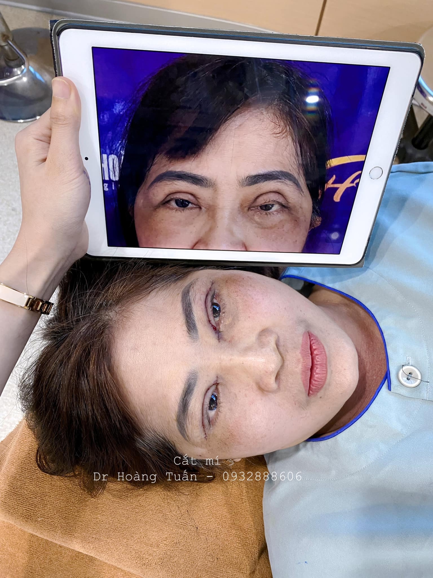 phẫu thuật thẩm mỹ mắt bị hỏng