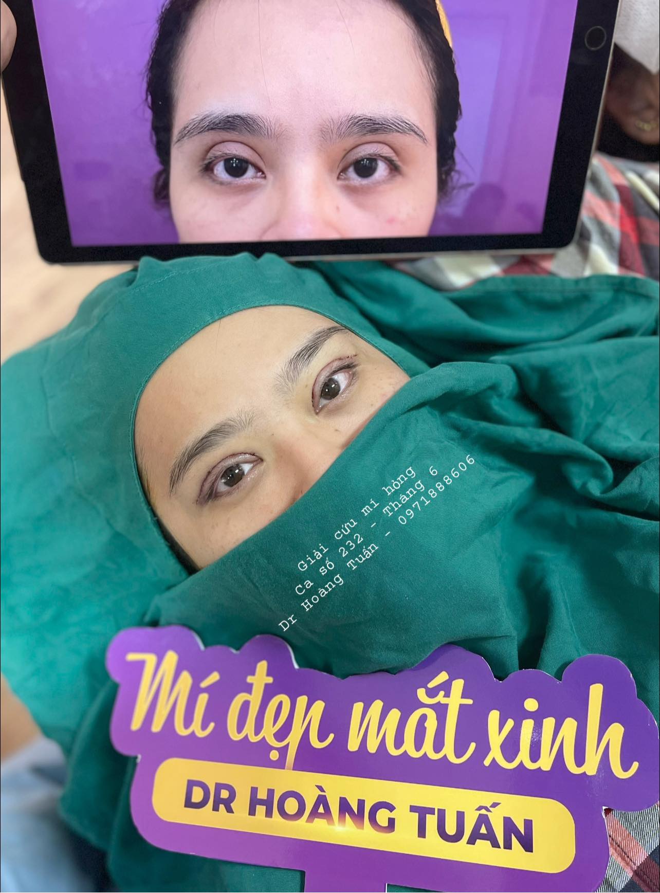 phẫu thuật thẩm mỹ mắt bị hỏng